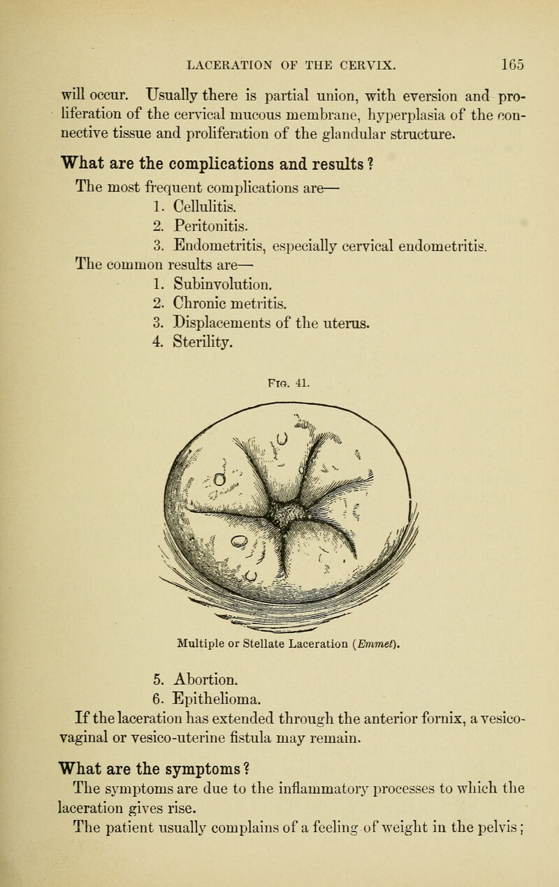 will occur. Usually there is partial union, with eversion and pro- liferation of the cemcal mucous membrane, hyperplasia of the con- nective tissue and proliferation of the glandular structure. What are the complications and results ? The most fi-equent complications are— 1. Cellulitis. 2. Peritonitis. 3. Endometritis, especially cervical endometritis. The common results are— 1. Subinvolution. 2. Chronic metritis. 3. Displacements of the uterus. 4. Sterility. Fig. 41. Multiple or Stellate Laceration {Emmet). 5. Abortion. 6. Epithehoma. If the laceration has extended through the anterior fornix, a vesico- vaginal or vesico-uterine fistula may remain. What are the symptoms ? The S3^mptoms are due to the inflammatory^ processes to which the laceration gives rise. The patient usually complains of a feeling of weight in the pelvis;