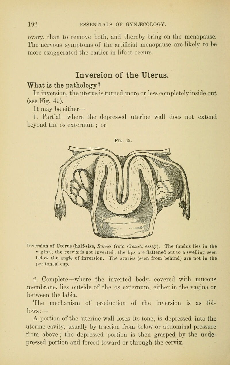 ovary, than to remove both, and thereby bring on the menopause. The nervous symptoms of the artificial menopause are hkely to be more exaecerated the earher in Ufe it occurs. Inversion of the Uterus. What is the pathology? In inversion, the uterus is turned more or less completely inside out (see Fig. 49). It may be either— 1. Partial—where the depressed uterine wall does not extend beyond the os externum ; or Fig. 49. Inversion of Uterus (half-size, Barnes from Crosse's essay). The fundus lies in the vagina; the cervix is not inverted; the lips are flattened out to a swellino: seen below the angle of inversion. The ovaries (seen from behind) are not in the peritoneal cup. 2. Complete—where the inverted body, covered with mucous membrane, lies outside of the os externum, either in the vagina or between the labia. The mechanism of production of the inversion is as fol- lows :— A portion of the uterine wall loses its tone, is depressed into the uterine cavity, usually by traction from below or abdominal pressure from above; the depressed portion is then grasped by the unde- pressed portion and forced toward or through the cervix.