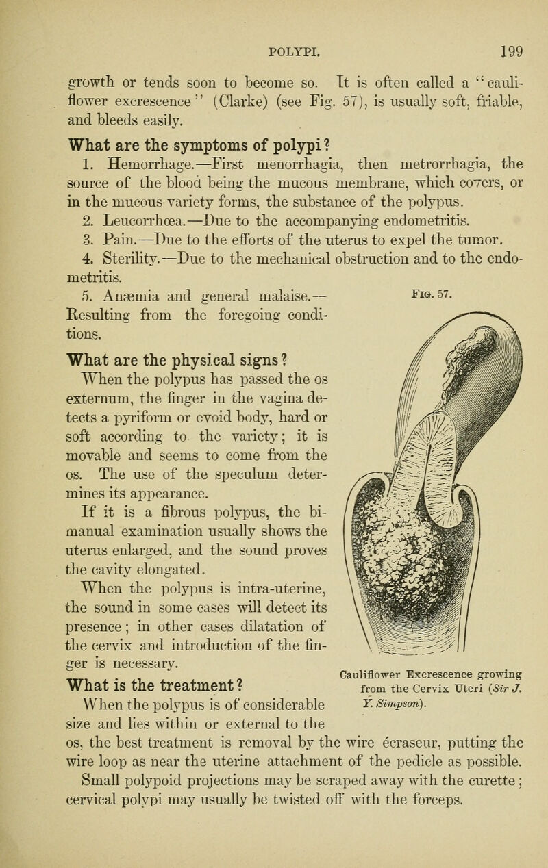 growth, or tends soon to become so. It is often called a cauli- flower excrescence (Clarke) (see Fig. 57), is usually soft, friable, and bleeds easily. What are the symptoms of polypi ? 1. Hemorrhage.—First menorrhagia, then metrorrhagia, the source of the blooa being the mucous membrane, which covers, or in the mucous variety forms, the substance of the polypus. 2. Leucorrhcea.—Due to the accompanying endometritis. 3. Pain.—Due to the efforts of the uterus to expel the tumor. 4. Sterility. —Due to the mechanical obstraction and to the endo- metritis. 5. Anaemia and general malaise.— Fig. 57. Resulting from the foregoing condi- tions. What are the physical signs ? When the polypus has passed the os externum, the finger in the vagina de- tects a pyiiform or ovoid body, hard or soft according to the variety; it is movable and seems to come from the OS. The use of the speculum deter- mines its appearance. If it is a fibrous polypus, the bi- manual examination usually shows the uterus enlarged, and the sound proves the cavity elongated. When the polypus is intra-uterine, the sound in some cases will detect its presence; in other cases dilatation of the cervix and introduction of the fin- ger is necessary. What is the treatment ? When the polypus is of considerable size and lies within or external to the OS, the best treatment is removal by the wire ecraseur, putting the wire loop as near the uterine attachment of the pedicle as possible. Small polypoid projections may be scraped away with the curette; cervical polypi may usually be twisted off with the forceps. Cauliflower Excrescence growing from the Cervix Uteri {Sir J. Y. Simpson).