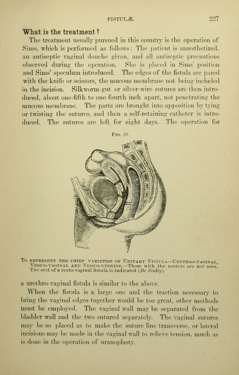 What is the treatment ? The treatment usually pursued in this country is the operation of Sims, which is performed as follows: The patient is anaesthetized, an antiseptic vaginal douche given, and all antiseptic precautions observed during the operation. She is placed in Sims' position and Sims' speculum introduced. The edges of the fistula are pared with the knife or scissors, the mucous membrane not being included in the incision. Silkworm-gut or silver-wire sutures are then intro- duced, about one-fifth to one-fourth inch apart, not penetrating the mucous membrane. The parts are brought into apposition by tying or twisting the sutures, and then a self-retaining catheter is intro- duced. The sutures are left for eight days. The operation for Fig. 59. To REPRESENT THE CHIEF VARIETIES OF URINARY FlSTlTLA—URETHku-VAGINaI , Vesicovaginal and Vesicouterine— Those with the ureters are not, seen! The seat of a recto-vaginal fistula is indicated (De Sinety). a urethro-vaginal fistula is similar to the above. When the fistula is a large one and the traction necessary to bring the vaginal edges together would be too great, other methods must be employed. The vaginal wall may be separated from the bladder wall and the two sutured separately. The vaginal sutures may be so placed as to make the suture line transverse, or lateral incisions may be made in the vaginal wall to relieve tension, much as is done in the operation of uranoplasty.