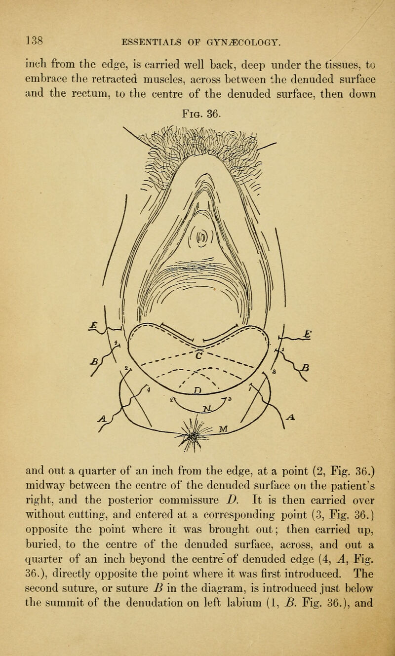 inch from the edge, is carried well back, deep under the tissues, to embrace the retracted muscles, across between the denuded surface and the rectum, to the centre of the denuded surface, then down Fig. 36. and out a quarter of an inch from the edge, at a point (2, Fig. 36.) midway between the centre of the denuded surface on the patient's right, and the posterior commissure D. It is then carried over without cutting, and entered at a corresponding point (3, Fig. 36.) opposite the point where it was brought out; then carried up, buried, to the centre of the denuded surface, across, and out a quarter of an inch bej^ond the centre of denuded edge (4, A, Fig. 36.), directly opposite the point where it was first introduced. The second suture, or suture B in the diagram, is introduced just below the summit of the denudation on left labium (1, ^. Fig. 36.), and