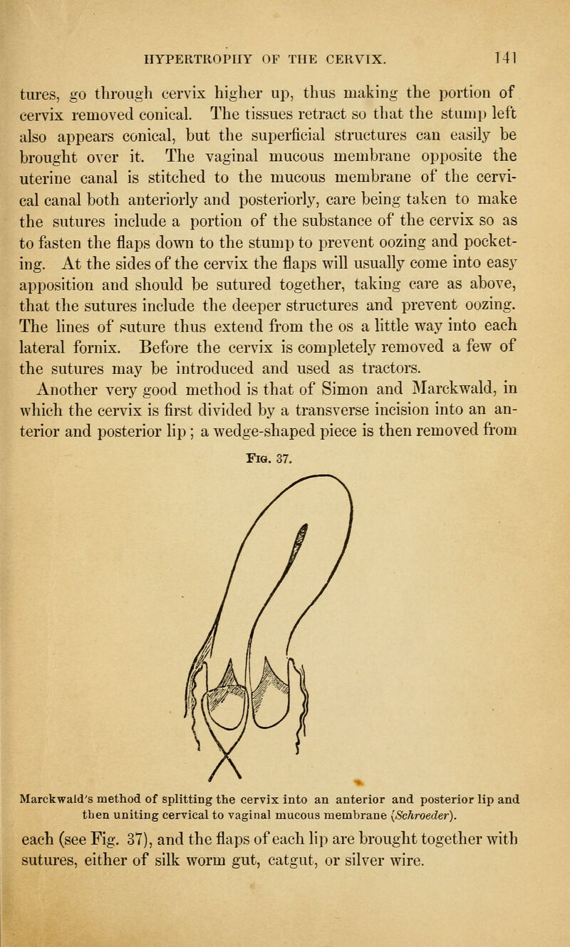 tures, go through cervix higher up, thus making the portion of cervix removed conical. The tissues retract so that the stump left also appears conical, but the superficial structures can easily be brought over it. The vaginal mucous membrane opposite the uterine canal is stitched to the mucous membrane of the cervi- cal canal both anteriorly and posteriorly, care being taken to make the sutures include a portion of the substance of the cervix so as to fasten the flaps down to the stump to prevent oozing and pocket- ing. At the sides of the cervix the flaps will usually come into easy apposition and should be sutured together, taking care as above, that the sutures include the deeper structures and prevent oozing. The lines of suture thus extend from the os a little way into each lateral fornix. Before the cervix is completely removed a few of the sutures may be introduced and used as tractors. Another very good method is that of Simon and Marckwald, in which the cervix is first divided by a transverse incision into an an- terior and posterior lip; a wedge-shaped piece is then removed from Fig. 37. Marckwald's method of splitting the cervix into an anterior and posterior lip and then uniting cervical to vaginal mucous membrane {Schroeder). each (see Fig, 37), and the flaps of each lip are brought together with sutures, either of silk worm gut, catgut, or silver wire.