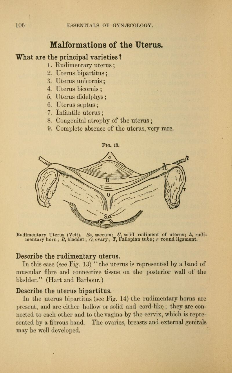 Malformations of the Uterus. What are the principal varieties ? 1. Rudimentary uterus; 2. Uterus bipartitus; 3. Uterus unicornis; 4. Uterus bicornis; 5. Uterus didelphys; 6. Uterus septus; 7. Infantile uterus; 8. Congenital atrophy of the uterus ; 9. Complete absence of the uterus, very rare. Fig. 13. Rudimentary Uterus (Veit). Sa, sacrum; U, solid rudiment of uterus; h, rudi- mentary horn; B, bladder; 0, ovary; T, Fallopian tube; r round ligament. Describe the rudimentary uterus. In this case (see Fig. 13) the uterus is represented by a band of muscular fibre and connective tissue on the posterior wall of the bladder.'' (Hart and Barbour.) Describe the uterus bipartitus. In the uterus bipartitus (see Fig. 14) the rudimentary horns are present, and are either hollow or solid and cord-like ; they are con- nected to each other and to the vagina by the cervix, which is repre- sented by a fibrous band. The ovaries, breasts and external genitals may be well developed.