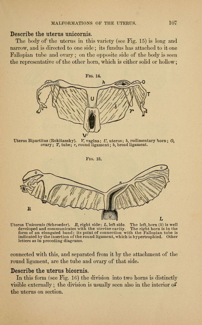 Describe the uterus unicornis. The body of the uterus in this variety (see Fig. 15) is long and narrow, and is directed to one side; its fundus has attached to it one Fallopian tube and ovary ; on the opposite side of the body is seen the representative of the other horn, which is either solid or hollow; Fig. 14. Uterus Bipartitus (Rokitansky). V, vagina; TJ, uterus; h, rudimentary horn; Ot ovary; T, tube; r, round ligament; b, broad ligament. Fig. 15. Uterus Unicornis (Schroeder). R, right side; L, left side. The left horn (h) is well developed and communicates with the uterine cavity. The rigrht horn is in 1he form of an elongated band; its point of connection with the Fallopian tube is indicated by the insertion of the round ligament, which is hypertrophied. Other letters as in preceding diagrams. connected with this, and separated from it by the attachment of the round ligament, are the tube and ovary of that side. Describe the uterus bicornis. In this form (see Fig. 16) the division into two horns is distinctly visible externally ; the division is usually seen also in the interior o£ the uterus on section.