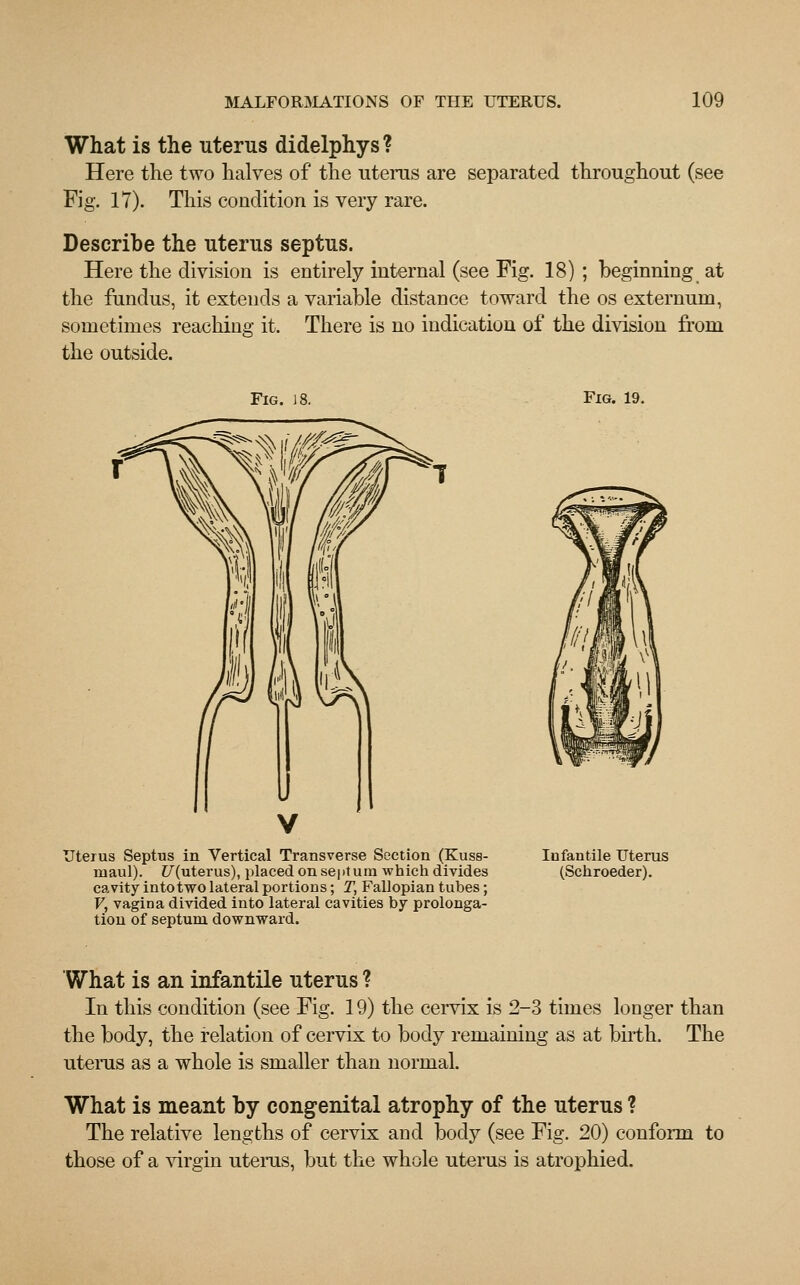 What is the uterus didelphys ? Here the two halves of the uterus are separated throughout (see Fig. 17). This condition is very rare. Describe the uterus septus. Here the division is entirely internal (see Fig. 18); beginning at the fundus, it extends a variable distance toward the os externum, sometimes reaching it. There is no indication of the division from the outside. Fig. 18. Fig. 19. Uterus Septus in Vertical Transverse Section (Kuss- maul). Z7(uterus), placed on septum which divides cavity into two lateral portions; T, Fallopian tubes; V, vagina divided into lateral cavities by prolonga- tion of septum downward. Infantile Uterus (Schroeder). What is an infantile uterus ? In this condition (see Fig. 19) the cervix is 2-3 times longer than the body, the relation of cervix to body remaining as at birth. The uterus as a whole is smaller than normal. What is meant by congenital atrophy of the uterus ? The relative lengths of cervix and body (see Fig. 20) conform to those of a virgin uterus, but the whole uterus is atrophied.