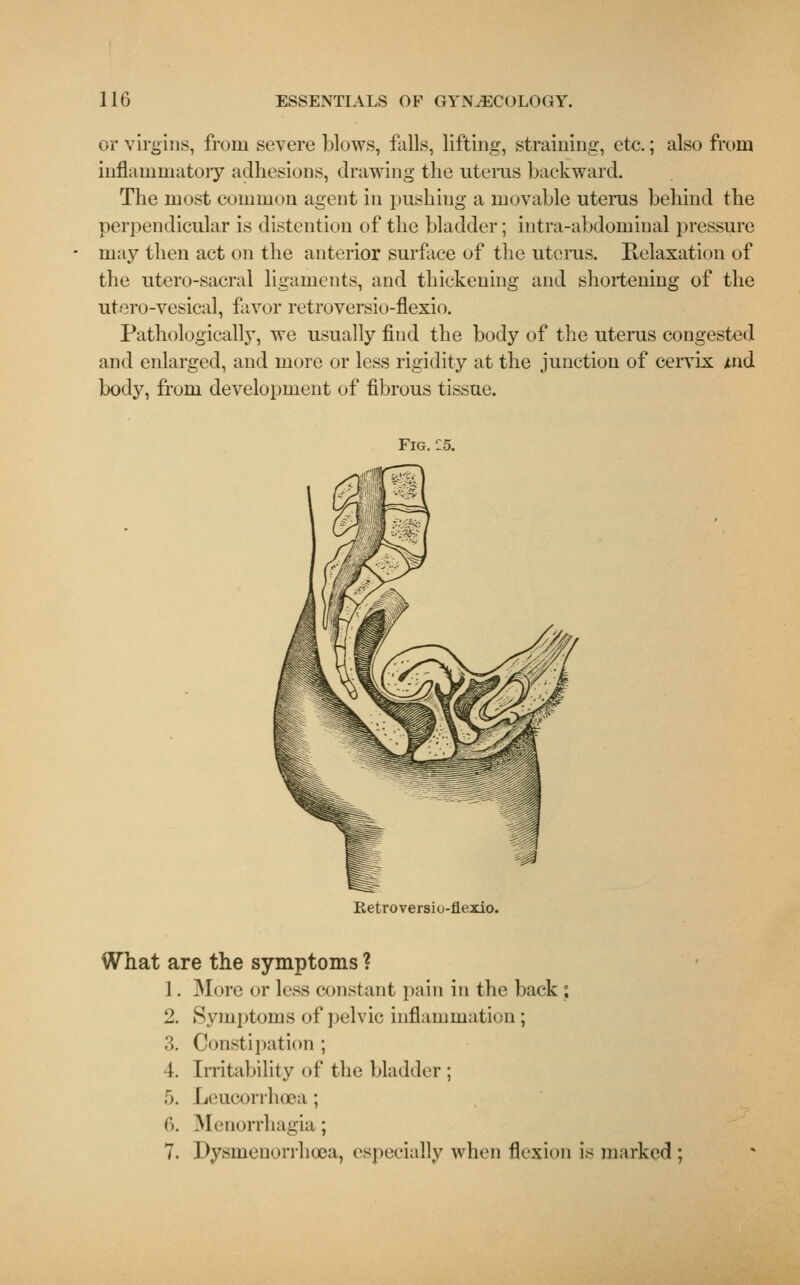or virgins, from severe blows, falls, lifting, straining, etc.; also from inflammatory adhesions, drawing the uterus backward. The most common agent in pushing a movable uterus behind the perpendicular is distention of the bladder; intra-abdominal pressure may then act on the anterior surface of the uterus. Relaxation of the utero-sacral ligaments, and thickening and shortening of the utero-vesical, favor retroversio-flexio. Pathologically, we usually find the body of the uterus congested and enlarged, and more or less rigidity at the junction of cervix And body, from development of fibrous tissue. Fig. C5. Retroversiu-flexio. What are the symptoms ? 1. More or less constant pain in the back °. 2. Symptoms of pelvic inflammation; 3. Constipation ; 4. Irritability of the bladder ; 5. Leucorrhoea ; 0. Menorrhagia; 7. Dysmenorrheea, especially when flexion is marked;