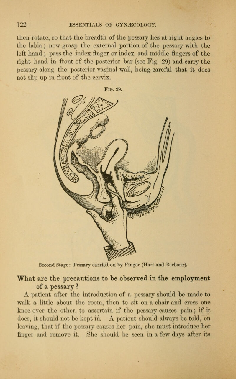 then rotate, so that the breadth of the pessary lies at right angles to the labia; now grasp the external portion of the pessary with the left hand ; pass the index finger or index and middle fingers of the right hand in front of the posterior bar (see Fig. 29) and cany the pessary along the posterior vaginal wall, being careful that it does not slip up in front of the cervix. Fig. 29. Second Stage: Pessary carried on by Finger (Hart and Barbour). What are the precautions to be observed in the employment of a pessary ? A patient after the introduction of a pessary should be made to walk a little about the room, then to sit on a chair and cross one knee over the other, to ascertain if the pessary causes pain; if it does, it should not be kept iii. A patient should always be told, on leaving, that if the pessary causes her pain, she must introduce her finger and remove it. She should be seen in a few days after its