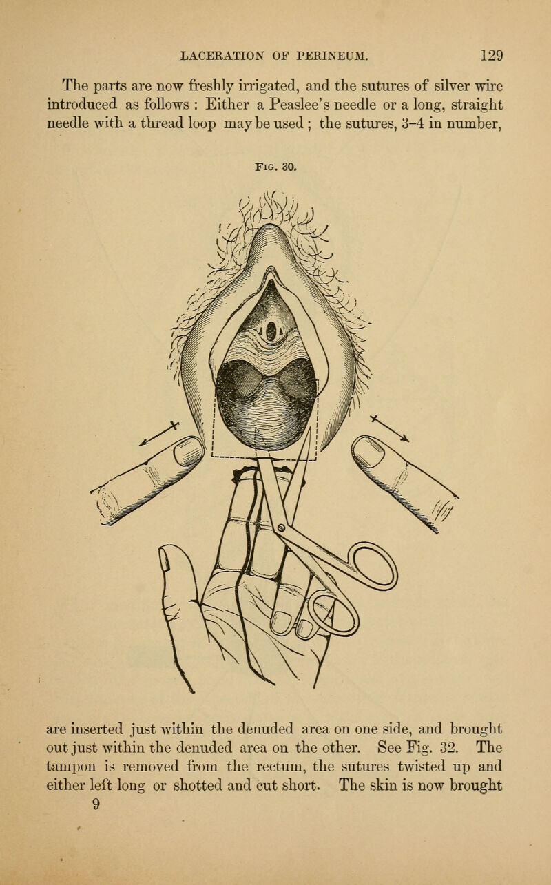 The parts are now freshly irrigated, and trie sutures of silver wire introduced as follows : Either a Peaslee's needle or a long, straight needle with a thread loop may be used ; the sutures, 3-4 in number, Fig. 30. are inserted just within the denuded area on one side, and brought out just within the denuded area on the other. See Fig. 32. The tampon is removed from the rectum, the sutures twisted up and either left long or shotted and cut short. The skin is now brought 9