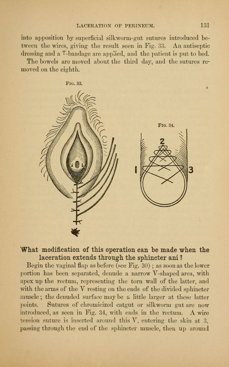 iDto apposition by superficial silkworm-gut sutures introduced be- tween the wires, giving the result seen in Fig. 33. An antiseptic dressing and a T-bandage are applied, and the patient is put to bed. The bowels are moved about the third day, and the sutures re- moved on the eighth. Fig. 33. Fig. 34. 'What modification of this operation can be made when the laceration extends through the sphincter ani ? Begin the vaginal flap as before (see Fig. 30) ; as soon as the lower portion has been separated, denude a narrow Y-shaped area, with apex up the rectum, representing the torn wall of the latter, and with the arms of the V resting on the ends of the divided sphincter muscle; the denuded surface may be a little larger at these latter points. Sutures of chromicized catgut or silkworm gut are now introduced, as seen in Fig. 34, with ends in the rectum. A wire tension suture is inserted around this V, entering the skin at 3, passing through the end of the sphincter muscle, then up around