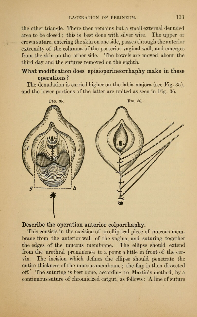the other triangle. There then remains but a small external denuded area to be closed ; this is best done with silver wire. The upper or crown suture, entering the skin on one side, passes through the anterior extremity of the columna of the posterior vaginal wall, and emerges from the skin on the other side. The bowels are moved about the third day and the sutures removed on the eighth. What modification does episioperineorrhaphy make in these operations ? The denudation is carried higher on the labia majora (see Fig. 35), and the lower portions of the latter are united as seen in Fig. 36. Fig. 35. Fig. 36. Describe the operation anterior colporrhaphy. This consists in the excision of an elliptical piece of mucous mem- brane from the anterior wall of the vagina, and suturing together the edges of the mucous membrane. The ellipse should extend from the urethral prominence to a point a little in front of the cer- vix. The incision which defines the ellipse should penetrate the entire thickness of the mucous membrane ; the flap is then dissected off.' The suturing is best done, according to Martin's method, by a continuous suture of chromicized catgut, as follows : A line of suture