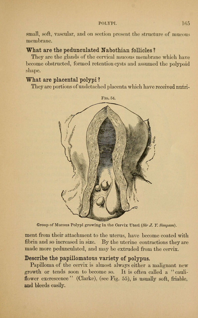 small, soft, vascular, and on section present the structure of mucous membrane. What are the pedunculated Nabothian follicles ? They are the glands of the cervical mucous membrane which have become obstructed, formed retention cysts and assumed the polypoid .shape. What are placental polypi ? They are portions of undetached placenta which have received nutri- Fig. 54. Group of Mucous Polypi growing in the Cervix Uteri (Sir J. Y. Simpson). ment from their attachment to the uterus, have become coated with fibrin and so increased in size. By the uterine contractions they are made more pedunculated, and may be extruded from the cervix. Describe the papillomatous variety of polypus. Papilloma of the cervix is almost always either a malignant new growth or tends soon to become so. It is often called a cauli- flower excrescence'' (Clarke), (see Fig. 55), is usually soft, friable. and bleeds easily.