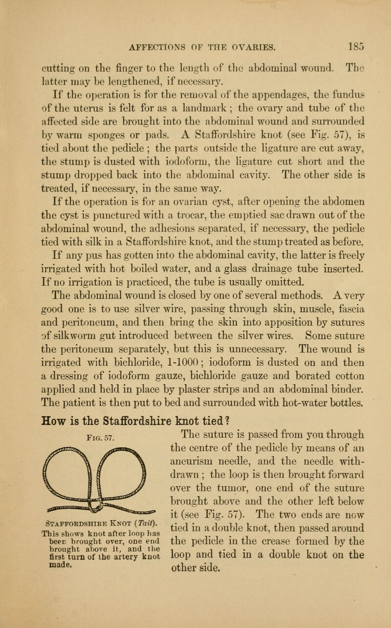 cutting on the finger to the length of the abdominal wound. The latter may be lengthened, if necessary. If the operation is for the removal of the appendages, the fundus of the uterus is felt for as a landmark ; the ovary and tube of the affected side are brought into the abdominal wound and surrounded by warm sponges or pads. A Staffordshire knot (see Fig. 57), is tied about the pedicle ; the parts outside the ligature are cut away, the stump is dusted with iodoform, the ligature cut short and the stump dropped back into the abdominal cavity. The other side is treated, if necessary, in the same way. If the operation is for an ovarian cyst, after opening the abdomen the cyst is punctured with a trocar, the emptied sac drawn out of the abdominal wound, the adhesions separated, if necessary, the pedicle tied with silk in a Staffordshire knot, and the stump treated as before, If any pus has gotten into the abdominal cavity, the latter is freely irrigated with hot boiled water, and a glass drainage tube inserted. If no irrigation is practiced, the tube is usually omitted. The abdominal wound is closed by one of several methods. A very good one is to use silver wire, passing through skin, muscle, fascia and peritoneum, and then bring the skin into apposition by sutures of silkworm gut introduced between the silver wires. Some suture the peritoneum separately, but this is unnecessary. The wound is irrigated with bichloride, 1-1000; iodoform is dusted on and then a dressing of iodoform gauze, bichloride gauze and borated cotton applied and held in place by plaster strips and an abdominal binder. The patient is then put to bed and surrounded with hot-water bottles. How is the Staffordshire knot tied ? FlG 57 The suture is passed from you through the centre of the pedicle by means of an aneurism needle, and the needle with- drawn ; the loop is then brought forward over the tumor, one end of the suture brought above and the other left below it (see Fig. 57). The two ends are now STAFFORDSHIRE KNOT (7^)- ^ fc ft fo^fe ^ ^ fl fl This shows knot after loop has * beer brought over, one end the pedicle in the crease formed by the brought above it, and the <. -\ ,• j • j t 1 1 ,i first turn of the artery knot loop and tied m a double knot on the made- other side.