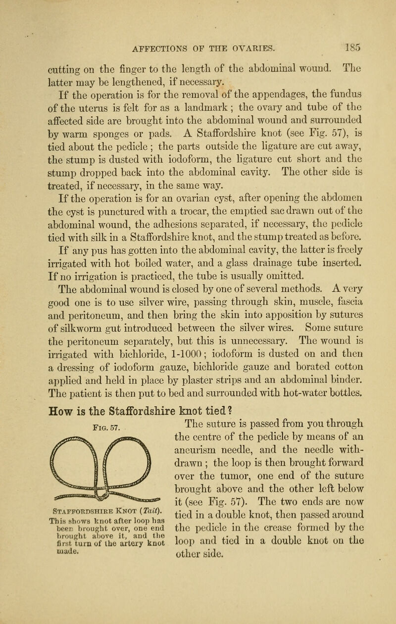 cutting on the finger to tlie length of the abdominal wound. Tlie latter may be lengthened, if necessary. If the operation is for the removal of the appendages, the fundus of the uterus is felt for as a landmark ; the ovary and tube of the affected side are brought into the abdominal wound and surrounded by warm sponges or pads. A Staffordshire knot (see Fig. 57), is tied about the pedicle ; the parts outside the ligature are cut away, the stump is dusted with iodoform, the Hgature cut short and the stump dropped back into the abdominal cavity. The other side is treated, if necessary, in the same way. If the operation is for an ovarian cyst, after opening the abdomen the cyst is punctured with a trocar, the emptied sac drawn out of the abdominal wound, the adhesions separated, if necessary, the pedicle tied with silk in a Staffordshire knot, and the stump treated as before. If any pus has gotten into the abdominal cavity, the latter is freely irrigated with hot boiled water, and a glass drainage tube inserted. If no irrigation is practiced, the tube is usually omitted. The abdominal wound is closed by one of several methods. A very good one is to use silver wire, passing through skin, muscle, fascia and peritoneum, and then bring the skin into apposition by sutures of silkworm gut introduced between the silver wires. Some suture the peritoneum separately, but this is unnecessary. The wound is irrigated with bichloride, 1-1000; iodoform is dusted on and then a dressing of iodoform gauze, bichloride gauze and berated cotton applied and held in place by plaster strips and an abdominal binder. The patient is then put to bed and surrounded with hot-water bottles. How is the Staffordshire knot tied? The suture is passed from you through the centre of the pedicle by means of an aneurism needle, and the needle with- drawn ; the loop is then brought forward over the tumor, one end of the suture brought above and the other left below it (see Fig. 57). The two ends are now tied in a double knot, then passed around the pedicle in the crease formed by the loop and tied in a double knot on the other side. Fig. 57. Staffordshire Knot (Taii). This shows knot after loop has beer hrought over, one end hrought above it, and the first turn of the artery knot made.
