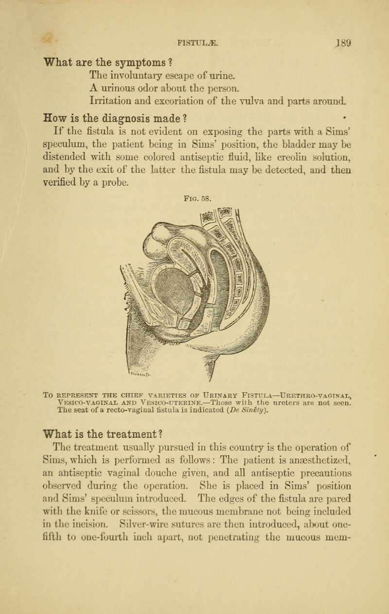 What are the symptoms ? The involuntary escape of urme. A urinous odor about the person. Irritation and excoriation of the vulva and parts around. How is the diagnosis made ? If the fistula is not evident on exposing the parts with a Sims' speculum, the patient being in Sims' position, the bladder may be distended with some colored antiseptic fluid, like creolin solution, and by the exit of the latter the fistula may be detected, and then verified by a probe. To REPRESENT THE CHIEF VARIETIES OF UrINARY FiSTIJXA—URETHRO-VAGINAI^ Vesico-vaginal and Vesico-uterine.—Those with the ureters are not seen. The seat of a recto-vaginal fistula is indicated {De Sinely). What is the treatment ? The treatment usually pursued in this country is the operation of Sims, which is performed as follows: The patient is anaesthetized, an ahtiseptic vaginal douche given, and all antiseptic precautions observed during the operation. She is placed in Sims' position and Sims' speculum introduced. The edges of the fistula are pared with the knife or scissors, the mucous membrane not being included in the incision. Silver-wire sutures are then introduced, al^Kjut one- fifth to onc-fuuith inch apait, not penetrating the mucous mem-