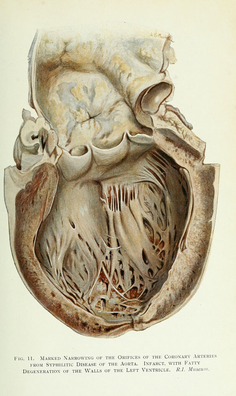 Fig. 11. Marked Xarrowixg of the Orifices of the Coronary Arteries FROM Syphilitic Disease of the Aorta. Infarct, with Fatty Degeneration of the Walls of the Left Ventricle. R.I. Museum.