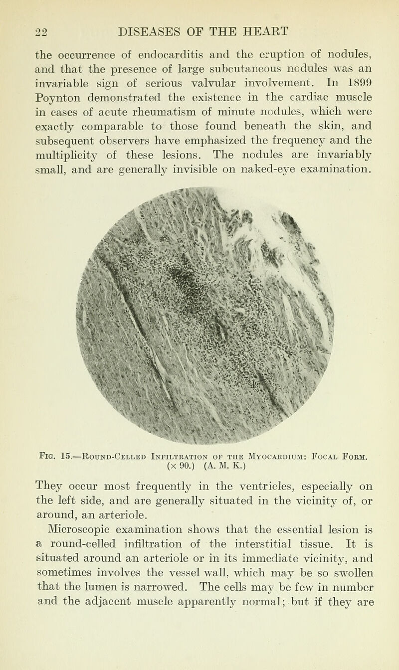 the occurrence of endocarditis and the eruption of nodules, and that the presence of large subcutaneous ncdules was an invariable sign of serious valvular involvement. In 1899 Pojaiton demonstrated the existence in the cardiac muscle in cases of acute rheumatism of minute nodules, which were exactly comparable to those found beneath the skin, and subsequent observers have emphasized the frequency and the multiphcity of these lesions. The nodules are invariably small, and are generally invisible on naked-eye examination. ^^[i^^, ;^;v:■:-i,•^^:N::^■;;,■ Fig. 15.—Round-Celled Infiltration of the Myocardium: Focal Form. (X 90.) (A. M. K.) They occur most frequently in the ventricles, especially on the left side, and are generally situated in the vicinity of, or around, an arteriole. jNIicroscopic examination shows that the essential lesion is a round-celled infiltration of the interstitial tissue. It is situated around an arteriole or in its immediate vicinity, and sometimes involves the vessel wall, which may be so swollen that the lumen is narrowed. The cells may be few in number and the adjacent muscle apparently normal; but if they are
