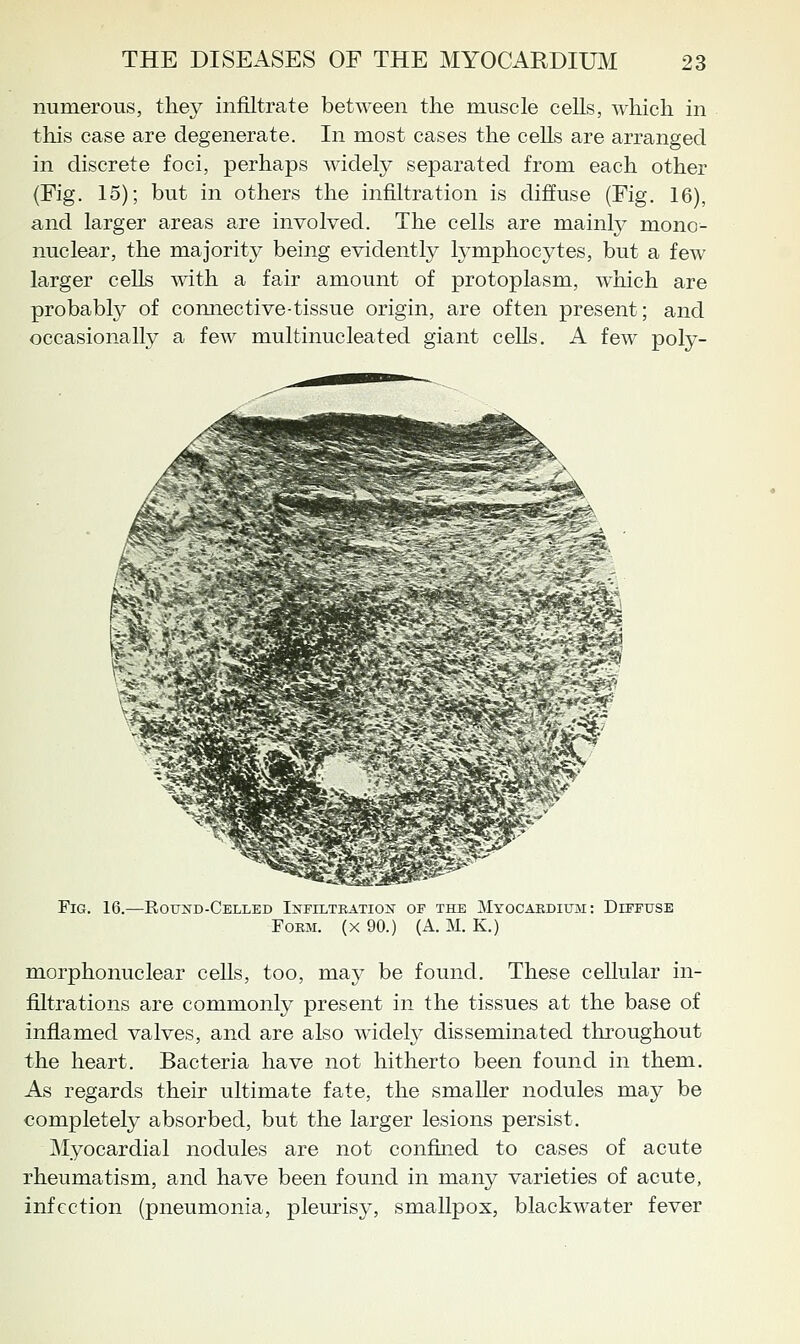 numerous, tliey inj&ltrate between the muscle cells, whicli in this case are degenerate. In most cases the cells are arranged in discrete foci, perhaps widely separated from each other (Fig. 15); but in others the infiltration is diffuse (Fig. 16), and larger areas are involved. The cells are mainl^^ mono- nuclear, the majority being evidently lymphocytes, but a few larger ceUs with, a fair amount of protoplasm, which are probabty of connective-tissue origin, are often present; and occasionally a few multinucleated giant cells. A few poly- FiG. 16.—Rouxd-Celled Infiltratiok of the Myocardium: Diffuse Form, (x 90.) (A. M. K.) morphonuclear cells, too, may be found. These cellular in- filtrations are commonly present in the tissues at the base of inflamed valves, and are also widely disseminated tliroughout the heart. Bacteria have not hitherto been found in them. As regards their ultimate fate, the smaller nodules may be completely absorbed, but the larger lesions persist. Myocardial nodules are not confined to cases of acute rheumatism, and have been found in many varieties of acute, infection (pneumonia, pleurisy, smallpox, blackwater fever