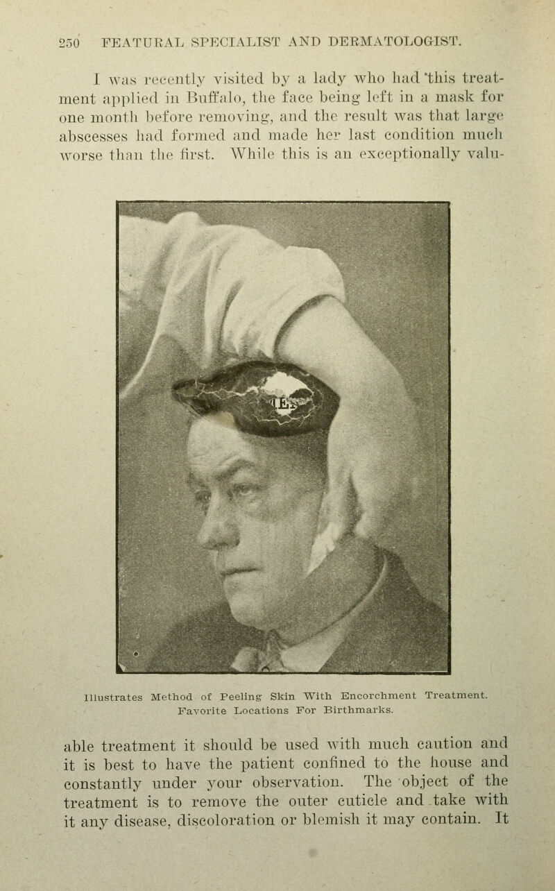 I was recently visited by a lady who had'this treat- ment applied in Buffalo, tlie face being loft in a mask for one month before removing, and the result was that large abscesses had formed and made her last condition mucli worse than the first. Whih^ this is an exceptionally valu- Illustrates Method of Peeling Skin With Encorchment Treatment. Favorite Locations For Birthmarks. able treatment it should be used with much caution and it is best to have the patient confined to the house and constantly under your observation. The object of the treatment is to remove the outer cuticle and take with it any disease, discoloration or blemish it may contain. It