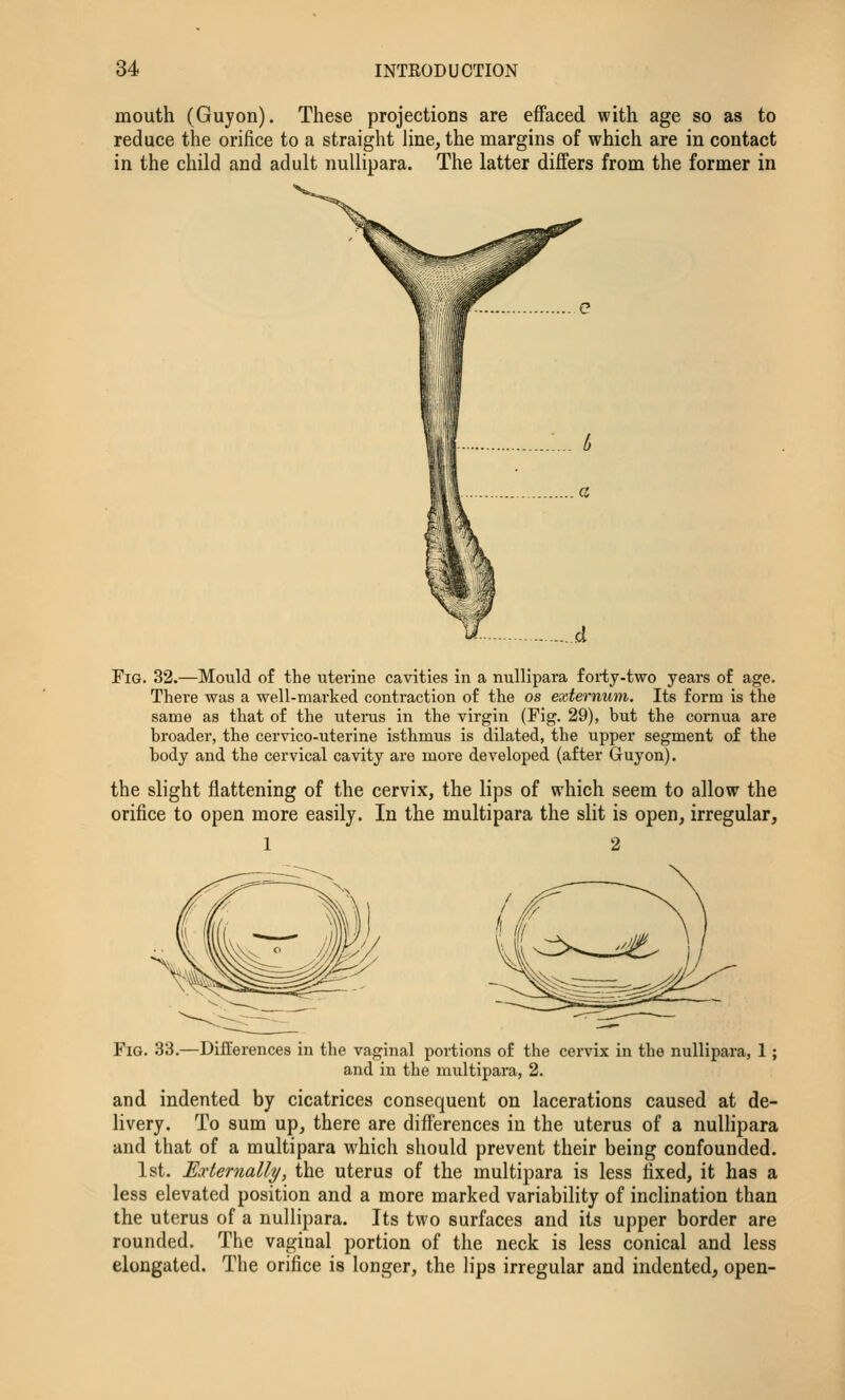 mouth (Guyon). These projections are effaced with age so as to reduce the orifice to a straight line, the margins of which are in contact in the child and adult nullipara. The latter differs from the former in Fig. 32.—Mould of the uterine cavities in a nullipara forty-two years of age. There was a well-marked contraction of the os externum. Its form is the same as that of the uterus in the virgin (Fig. 29), but the cornua are broader, the cervico-uterine isthmus is dilated, the upper segment of the body and the cervical cavity are more developed (after Guyon). the slight flattening of the cervix, the lips of which seem to allow the orifice to open more easily. In the multipara the slit is open, irregular, 1 2 Fig. 33.—Differences in the vaginal portions of the cervix in the nullipara, 1; and in the multipara, 2. and indented by cicatrices consequent on lacerations caused at de- livery. To sum up, there are differences in the uterus of a nullipara and that of a multipara which should prevent their being confounded. 1st. Externally, the uterus of the multipara is less fixed, it has a less elevated position and a more marked variability of inclination than the uterus of a nullipara. Its two surfaces and its upper border are rounded. The vaginal portion of the neck is less conical and less elongated. The orifice is longer, the lips irregular and indented, open-