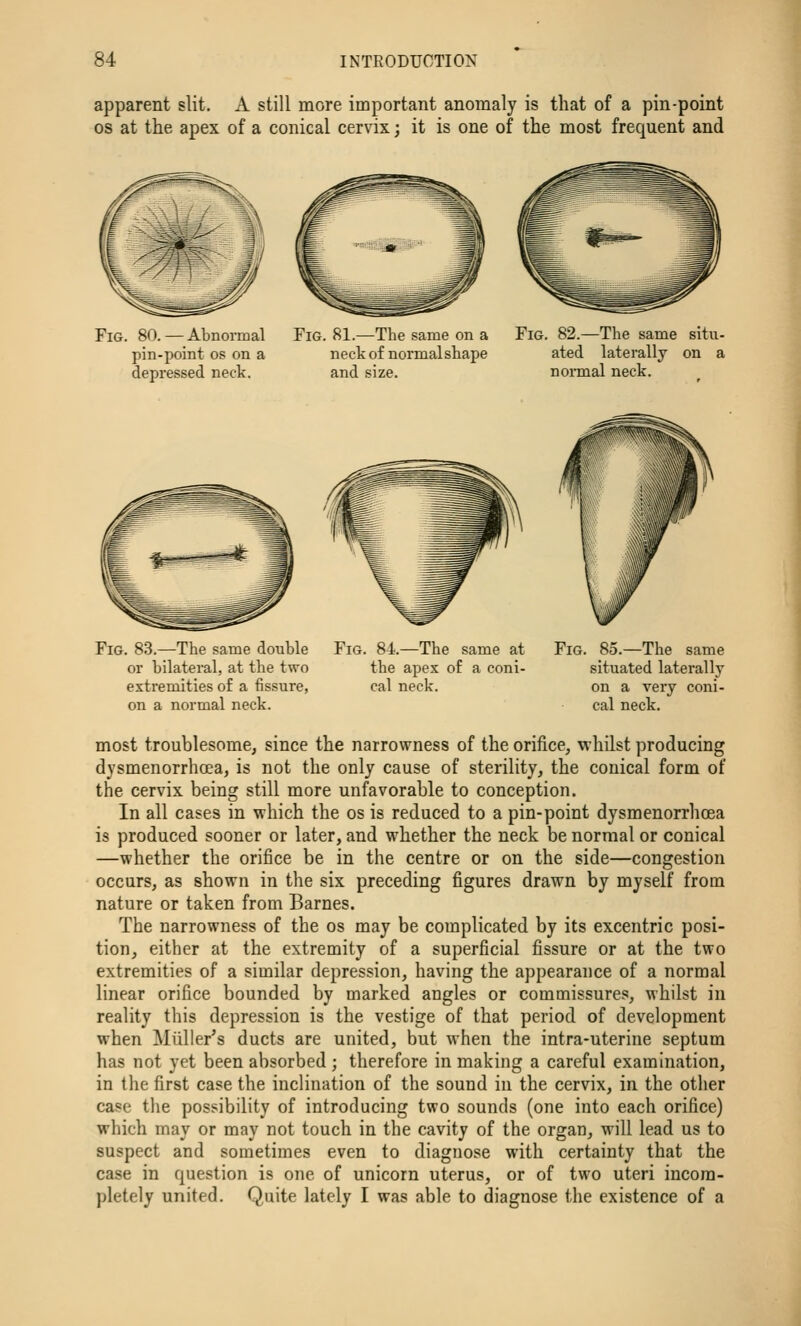 apparent slit. A still more important anomaly is that of a pin-point OS at the apex of a conical cervix; it is one of the most frequent and Fig. 80. — Abnonnal pin-point os on a depressed neck. Fig. 81.—The same on a neck of normalshape and size. Fig. 82.—The same situ- ated laterally on a normal neck. Fig. 83.—The same double or bilateral, at the two extremities of a fissure, on a normal neck. Fig. 84.—The same at the apex of a coni- cal neck. Fig. 85.—The same situated laterally on a very coni- cal neck. most troublesome, since the narrowness of the orifice, whilst producing dysmenorrhoea, is not the only cause of sterility, the conical form of the cervix being still more unfavorable to conception. In all cases in which the os is reduced to a pin-point dysmenorrhoea is produced sooner or later, and whether the neck be normal or conical —whether the orifice be in the centre or on the side—congestion occurs, as shown in the six preceding figures drawn by myself from nature or taken from Barnes. The narrowness of the os may be complicated by its excentric posi- tion, either at the extremity of a superficial fissure or at the two extremities of a similar depression, having the appearance of a normal linear orifice bounded by marked angles or commissures, whilst in reality this depression is the vestige of that period of development when Miiller's ducts are united, but when the intra-uterine septum has not yet been absorbed ; therefore in making a careful examination, in the first case the inclination of the sound in the cervix, in the other case the possibility of introducing two sounds (one into each orifice) which may or may not touch in the cavity of the organ, will lead us to suspect and sometimes even to diagnose with certainty that the case in question is one of unicorn uterus, or of two uteri incom- pletely united. Quite lately I was able to diagnose the existence of a