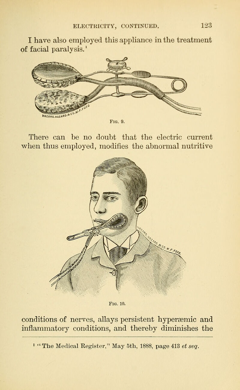 ELECTRICITY, CONTINUED. I have also employed this appliance in the treatment of facial paralysis.' Fig. 9. There can be no doubt that the electric current when thus employed, modifies the abnormal nutritive Hfes** Fig. 10. conditions of nerves, allays persistent hyperaemic and inflammatory conditions, and thereby diminishes the  The Medical Register, May 5th, 1888, page 413 et seq.