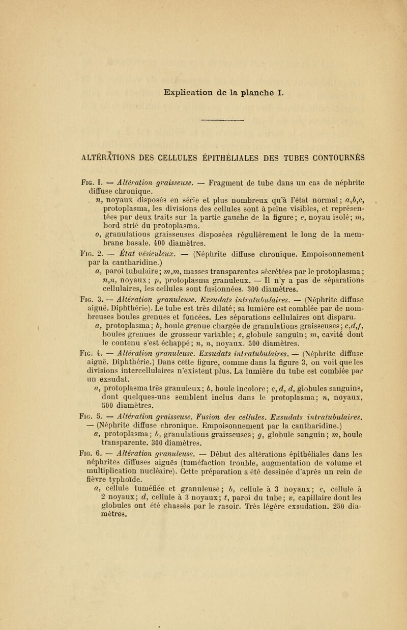 Explication de la planche I. ALTÉRATIONS DES CELLULES ÉPITHÉLIALES DES TUBES CONTOURNÉS Fig. I. — Altération graisseuse. — Fragment de tube dans un cas de néphrite diffuse chronique. n, noyaux disposés en série et plus nombreux qu'à l'état normal ; a,b,c, protoplasma, les divisions des cellules sont à peine visibles, et représen- tées par deux traits sur la partie gauche de la figure; e, noyau isolé; m, bord strié du protoplasma. o, granulations graisseuses disposées régulièrement le long de la mem- brane basale. 400 diamètres. Fig. 2. — Etat vésiculeux. — (Néphrite diffuse chronique. Empoisonnement par la cantharidine.) a, paroi tubulaire; m,m, masses transparentes sécrétées par le protoplasma; w,n, noyaux; p, protoplasma granuleux. — Il n'y a pas de séparations cellulaires, les cellules sont fusionnées. 300 diamètres. Fig. 3. — Altération granuleuse. Exsudais intratubulaires. — (Néphrite diffuse aiguë. Diphthérie). Le tube est très dilaté; sa lumière est comblée par de nom- breuses boules grenues et foncées. Les séparations cellulaires ont disparu. a, protoplasma; b, boule grenue chargée de granulations graisseuses; c,d,f, boules grenues de grosseur variable; e, globule sanguin; m, cavité dont le contenu s'est échappé; n, n, noyaux. 500 diamètres. Fig. 4. — Altération granuleuse. Exsudats intratubulaires. — (Néphrite diffuse aiguë. Diphthérie.) Dans cette figure, comme dans la figure 3, on voit que les divisions intercellulaires n'existent plus. La lumière du tube est comblée par un exsudât. «, protoplasma très granuleux; 6, boule incolore; c, d, d, globules sanguins, dont quelques-uns semblent inclus dans le protoplasma; n, noyaux, 500 diamètres. Fig. 5. — Altération graisseuse. Fusion des cellules. Exsudats intratubulaires. — (Néphrite diffuse chronique. Empoisonnement par la cantharidine.) a, protoplasma; b, granulations graisseuses; g, globule sanguin; m, boule transparente. 300 diamètres. Fig. 6. — Altération granuleuse. — Début des altérations épithéliales dans les néphrites diffuses aiguës (tuméfaction trouble, augmentation de volume et multiplication nucléaire). Cette préparation a été dessinée d'après un rein de fièvre typhoïde. a, cellule tuméfiée et granuleuse; b, cellule à 3 noyaux; c, cellule à 2 noyaux; d, cellule à 3 noyaux; t, paroi du tube; v, capillaire dont les globules ont été chassés par le rasoir. Très légère exsudation. 250 dia- mètres.