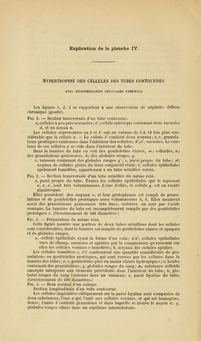 HYPERTROPHIE DES CELLULES DES TUBES CONTOURNÉS AVEC DESINTEGRATION CELLULAIRE PARTIELLE Les figures 1, 2, 3 se rapportent à une observation de néphrite diffuse chronique (goutte). Fig. 1. — Section transversale d'un tube contourné. a, cellules à peu près normales ; «, cellule sphérique contenant trois vacuoles d, et un noyau n. Les cellules représentées en b et b' ont un volume de 3 à 10 fois plus con- sidérable que la cellule a. — La cellule b' contient deux noyaux; o,r, granula- tions protéiques contenues dans l'intérieur des cellules; d',d', vacuoles. Le con- tenu de ces cellules u se vide dans l'intérieur du tube. Dans la lumière du tube en voit des gouttelettes claires, m; colloïdes, n; des granulations graisseuses, h; des globules rouges, g. c, vaisseau contenant des globules rouges g' ; s, paroi propre du tube ; et, noyaux de cellules plates du tissu conjonctif rénal; t, cellules épithéliales également tuméfiées, appartenant à un tube urinifère voisin. Fig. 2. — Section transversale d'un tube urinifère du même rein. s, paroi propre du tube. Toutes les cellules épithéliales qui le tapissent a, a, a', sont très volumineuses. L'une d'elles, la cellule g, est en réalité gigantesque. Elles possèdent des noyaux n, et leur protoplasma est rempli de granu- lations et de gouttelettes protéiques assez volumineuses à, b. Elles montrent aussi des granulations graisseuses très fines, colorées en noir par l'acide osmique. La lumière du tube est incomplètement remplie par des gouttelettes protéiques e. (Grossissement de 400 diamètres.) Fig. 3. — Préparation du même rein. Cette figure montre une portion de deux tubes urinifères dont les cellules sont considérables, dont la lumière est remplie de gouttelettes claires et opaques et de globules rouges. u, cellule épithéliale ayant la forme d'un coin; d'à, cellules épithéliales vues de champ, amincies et aplaties par la compression qu'exercent sur elles les cellules voisines c tuméfiées ; b, noyaux des cellules aplaties. Les cellules tuméfiées c, c'c' contiennent une quantité considérable de gra- nulation? ou gouttelettes protéiques, qui sont versées par les cellules dans la lumière des tubes ; e, e, gouttelettes plus ou moins claires hydropiques ; o, boules contenant des granulations; g, globules rouges du sang; m, substance colloïde amorphe interposée aux éléments précédents dans l'intérieur du tube; h, glo- bules rouges du sang contenus dans un vaisseau; s, paroi hyaline du tube. (Grossissement de 400 diamètres.) Fig. 4. — Rein normal d'un cobaye. Section longitudinale d'un tube contourné. Les cellules implantées obliquement sur la paroi hyaline sont composées de deux substances, l'une a qui l'unit aux cellules voisines, et qui est homogène, dense; l'autre b centrale granuleuse et dans laquelle se trouve le noyau ?i; g. globules rouges situés dans un capillaire intertubulaire.