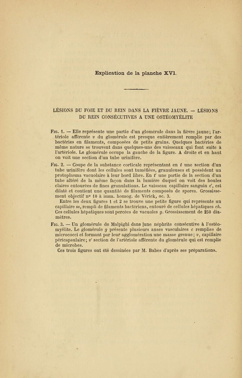 Explication de la planche XVI. LESIONS DU FOIE ET DU REIN DANS LA FIÈVRE JAUNE. — LÉSIONS DU RELN CONSÉCUTIVES A UNE OSTÉOMYÉLITE Fig. 1. — Elle représente une partie d'un glomérule dans la fièvre jaune; l'ar- tériole afférente v du glomérule est presque entièrement remplie par des bactéries en filaments, composées de petits grains. Quelques bactéries de même nature se trouvent dans quelques-uns des vaisseaux qui font suite à l'artériole. Le glomérule occupe la gauche de la figure. A droite et en haut on voit une section d'un tube urinifère. Fig. 2. — Coupe de la substance corticale représentant en t une section d'un tube urinifère dont les cellules sont tuméfiées, granuleuses et possèdent un protoplasma vacuolaire à leur bord libre. En f une partie de la section d'un tube altéré de la même façon dans la lumière duquel on voit des boules claires entourées de fines granulations. Le vaisseau capillaire sanguin c', est dilaté et contient une quantité de filaments composés de spores. Grossisse- ment objectif n° 10 à imm. homog. de Vérick, oc. 3. Entre les deux figures 1 et 2 se trouve une petite figure qui représente un capillaire m, rempli de filaments bactériens, entouré de cellules hépatiques ch. Ces cellules hépatiques sont percées de vacuoles g. Grossissement de 250 dia- mètres. Fig. 3. — Un glomérule de Malpighi dans [une néphrite consécutive à l'ostéo- myélite. Le glomérule g présente plusieurs anses vasculaires c remplies de micrococci et formant par leur agglomération une masse grenue; v, capillaire péricapsulaire ; v' section de l'artériole afférente du glomérule qui est remplie de microbes. Ces trois figures ont été dessinées par M. Rabes d'après ses préparations..