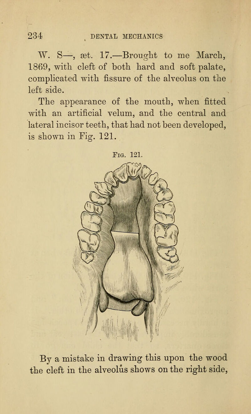 W. S—J a3t. 17.—Brouglit to me Marcli, 1869, with cleft of both hard and soft palate, complicated with fissure of the alveolus on the left side. The appearance of the mouth, when fitted with an artificial velum, and the central and lateral incisor teeth, that had not been developed. is shown in Fig. 121. Fig. 121. By a mistake in drawing this upon the wood the cleft in the alveolus shows on the right side,