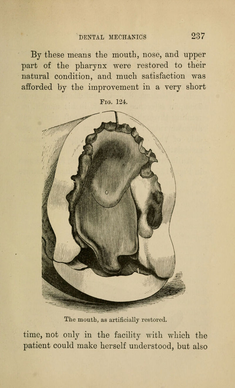By these means the mouth, nose, and upper part of the pharynx were restored to their natural condition, and much satisfaction was afforded by the improvement in a very short Fig. 124. Tlie mouth, as artificially restored. time, not only in the facihty with which the patient could make herself understood, but also