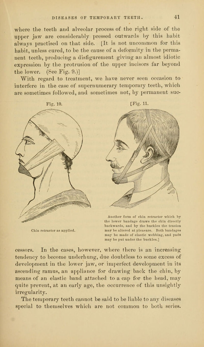 where the teeth and alveolar process of the right side of the upper jaw are considerably pressed outwards hy this habit always practised on that side. [It is not uncommon for this habit, unless cured, to be the cause of a deformity in the perma- nent teeth, producing a disfigurement giving an almost idiotic expression by the protrusion of the upper incisors fiir beyond the lower. (See Fig. 9.)] With regard to treatment, we have never seen occasion to interfere in the case of supernumerary temporary teeth, which are sometimes followed, and sometimes not, by permanent suc- Fig. 10. [Fig. 11. Chin retractor as applied. Another form of chin retractor which by the lower bandage draws the chin directly backwards, and by the buckles the tension may be altered at pleasure. Both bandages may be made of elastic webbing, and pads may be put under the buckles.] cessors. In the cases, however, where there is an increasing tendency to become underhung, due doubtless to some excess of development in the lower jaw, or imperfect development in its ascending ramus, an applinnce for drawing back the chin, by means of an elastic band attached to a cap for the head, may quite prevent, at an early age, the occurrence of this unsightly irregularity. The temporary teeth cannot be said to be liable to any diseases special to themselves which are not common to both series.