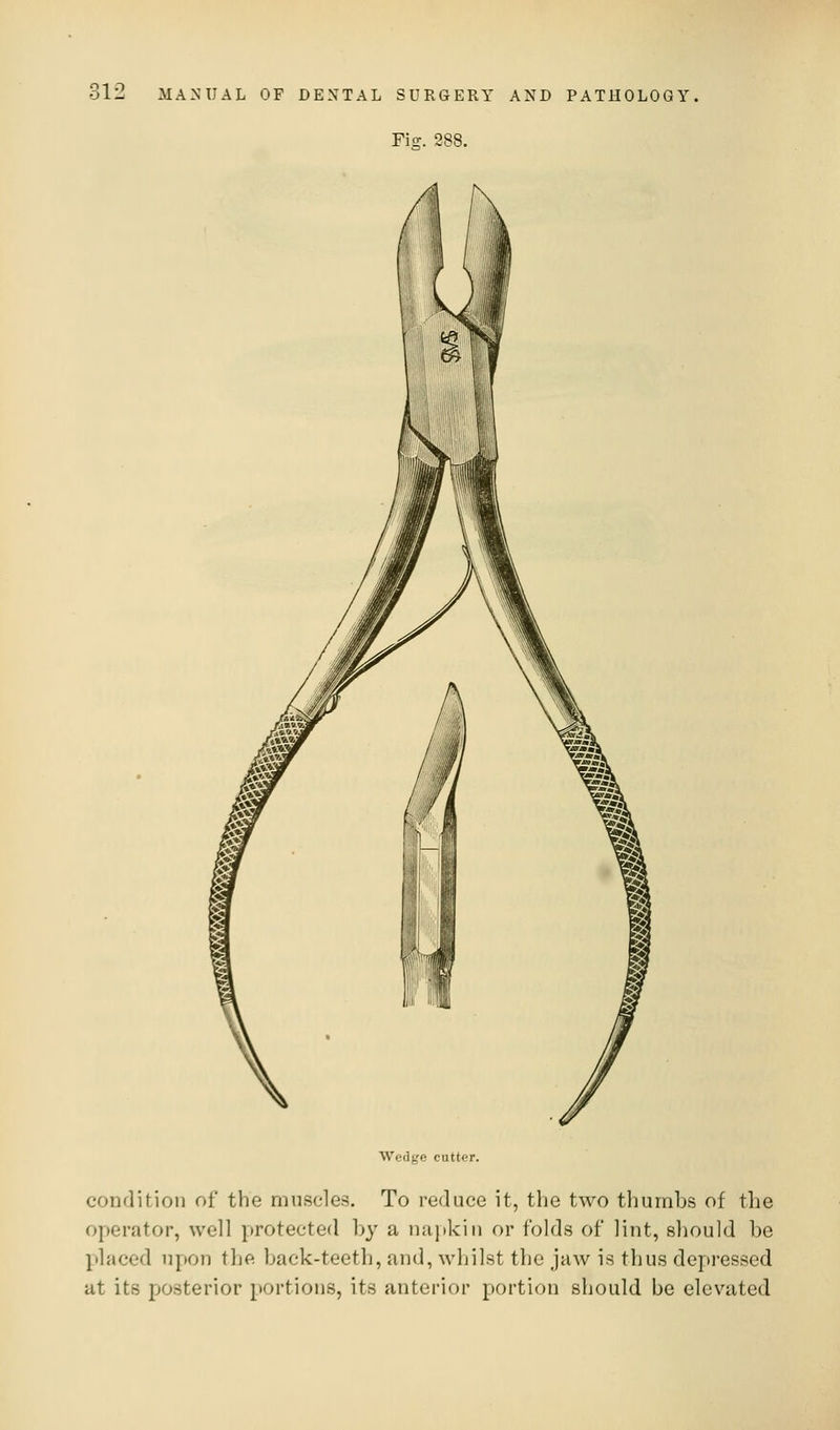 Fio;. 288. Wedge cutter. condition of the muscles. To reduce it, the two thumbs of the operator, well protected by a nuitkin or folds of lint, should be placed upon the back-teeth, and, whilst the jaw is thus dcpi-essed at its posterior portions, its anterior portion should be elevated