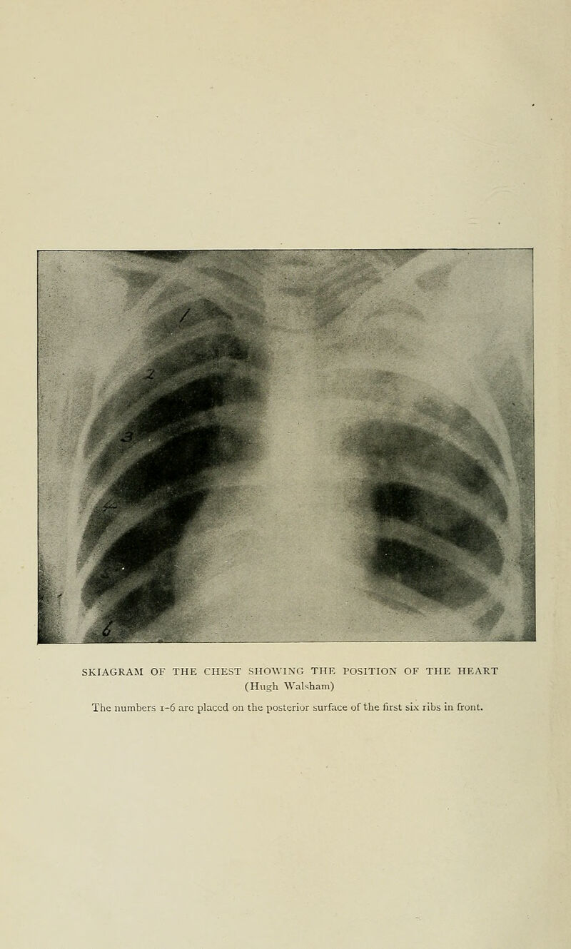 SKIAGRAM OF THE CHEST SHOWING THE POSITION OF THE HEART (Hugh Walsham) The numbers i-6 arc placed on the posterior surface of the first six ribs in front.