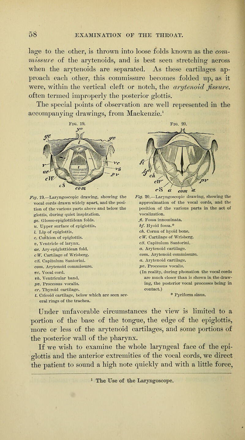 lage to the other, is thrown into loose folds known as the co7)%- onissure of the arytenoids, and is best seen stretching across when the arytenoids are sejDarated. As these cartilages ap- proach each other, this commissure becomes folded up, as it were, within the vertical cleft or notch, the arytenoid fissure. often termed improperly the posterior glottis. The special points of observation are well represented in the accompanying drawings, from Mackenzie.^ Fig. 20. Fig. 19.—Laryngosoopic drawing, showing the vocal cords drawn widely apart, and the posi- tion of the various parts above and below the glottis, during quiet inspiration. ge. Glosso-epiglottidean folds. u. Upper surface of epiglottis, I. Lip of epiglottis, c. Cushion of epiglottis. V. Ventricle of larynx. ae. Ary-epiglottidean fold, c W. Cartilage of Wrisberg. cS. Capitulum Santorini. com. Arytenoid commissure. PC. Vocal cord. t)&. Ventricular band. pv. Processus vocalis. cr. Thyroid cartilage. t. Cricoid cartilage, below which are seen sev- eral rings of the trachea. Under unfavorable circumstances the view is limited to a portion of the base of the tongue, the edge of the epiglottis, imore or less of the arytenoid cartilages, and some portions of the posterior wall of the pharynx. If we wish to examine the whole laryngeal face of the epi- glottis and the anterior extremities of the vocal cords, we direct the patient to sound a high note quickly and with a little force. I com ■ Fig. 20.—Laryngosoopic drawing, showing the approximation of the vocal cords, and the position of the various parts in the act of vocalization. fl. Fossa innoininata. t)f. Hyoid fossa.* ch. Cornu of hyoid bone. c W. Cartilage of Wrisberg. cS. Capitulum Santorini. a. Arytenoid cartUage. com. Arytenoid commissure. a. Arytenoid cartilage. pv. Processus vocalis. (In reality, during phonation the vocal cords are much closer than is shown in the draw- ing, the posterior vocal processes being in contact.) * Pyriform sinus. ' The Use of the Laryngoscope.