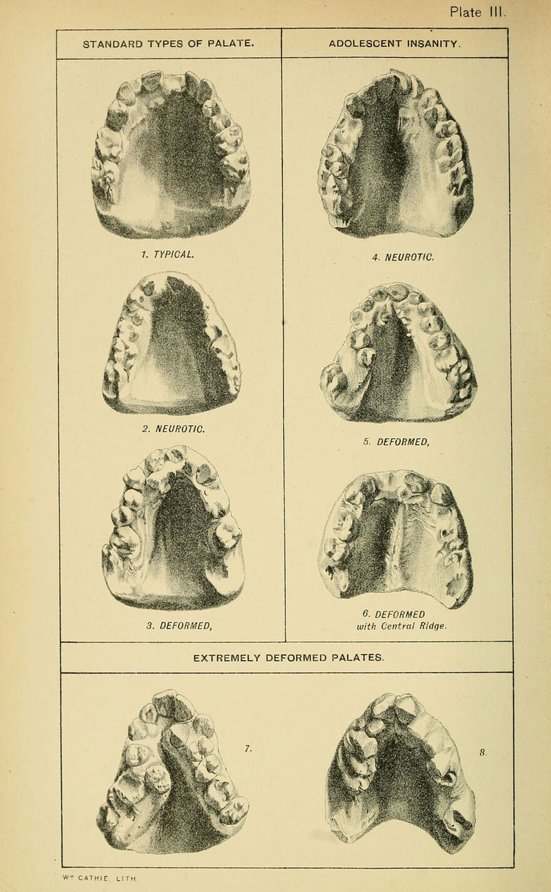 STANDARD TYPES OF PALATE. ADOLESCENT INSANITY. 1. TYPICAL 2. NEUROTIC. 3. DEFORMED, 4. NEUROTIC. 5. DEFORMED, 6. DEFORMED with Central Ridge. EXTREMELY DEFORMED PALATES. W CATHIE LITH