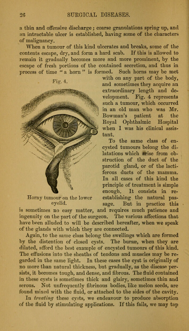 a thin and offensive discharge; coarse granulations spring up, and an intractable ulcer is established, having some of the characters of malignancy. When a tumour of this kind ulcerates and breaks, some of the contents escape, dry, and form a hard scab. If this is allowed to remain it gradually becomes more and more prominent, by the escape of fresh portions of the contained secretion, and thus in process of time  a horn  is formed. Such horns may be met with on any part of the body, Fig. 4. Horny tumour on the lower eyelid. and sometimes they acquire an extraordinary length and de- velopment. Fig. 4 represents such a tumour, which occurred in an old man who was Mr. Bowman's patient at the Royal Ophthalmic Hospital when I was his clinical assis- tant. To the same class of en- cysted tumours belong the di- latations which arise from ob- struction of the duct of the parotid gland, or of the lacti- ferous ducts of the mamma. In all cases of this kind the principle of treatment is simple enough. It consists in re- establishing the natural pas- sage. But in practice this is sometimes no easy matter, and requires much patience and ingenuity on the part of the surgeon. The various affections that have been alluded to will be described hereafter, when we speak of the glands with which they are connected. Again, to the same class belong the swellings which are formed by the distention of closed cysts. The bursse, when they are dilated, afford the best example of encysted tumoi\rs of this kind. The effusions into the sheaths of tendons and muscles may be re- garded in the same light. In these cases the cyst is originally of no more than natural thickness, but gradually, as the disease per- sists, it becomes tough, and dense, and fibrous. The fluid contained in these cysts is sometimes thick and glairy, sometimes thin and serous. Not unfrequently fibrinous bodies, like melon seeds, are found mixed with the fluid, or attached to the sides of the cavity. In treating these cysts, we endeavour to produce absorption of the fluid by stimulating applications. If this fails, we may tap