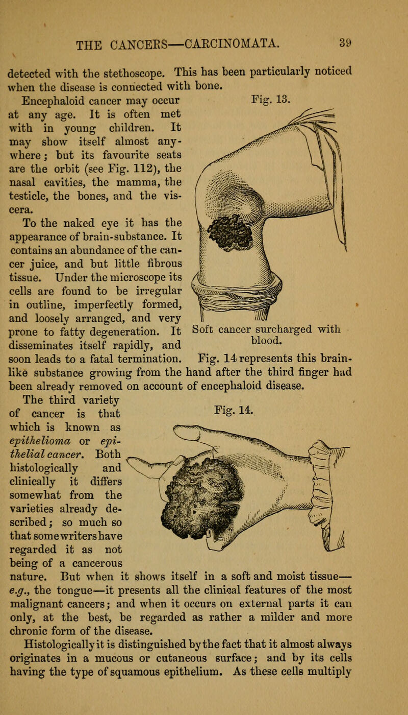 detected with the stethoscope. This has heen particularly noticed when the disease is connected with bone. Encephaloid cancer may occur at any age. It is often met with in young children. It may show itself almost any- where ; but its favourite seats are the orbit (see Fig. 112), the nasal cavities, the mamma, the testicle, the bones, and the vis- cera. To the naked eye it has the appearance of brain-substance. It contains an abundance of the can- cer juice, and but little fibrous tissue. Under the microscope its cells are found to be irregular in outline, imperfectly formed, and loosely arranged, and very prone to fatty degeneration. It disseminates itself rapidly, and soon leads to a fatal termination. Soft cancer surcharged with blood. Fig. 14 represents this brain- like substance growing from the hand after the third finger had been already removed on account of encephaloid disease. The third variety of cancer is that -^^S* ■^^* which is known as epithelioma or ejoi- thelial cancer. Both histologically and clinically it difiiers somewhat from the varieties already de- scribed; so much so that somewritershave regarded it as not being of a cancerous nature. But when it shows itself in a soft and moist tissue— e.ff., the tongue—it presents all the clinical features of the most malignant cancers; and when it occurs on external parts it can only, at the best, be regarded as rather a milder and more chronic form of the disease. Histologically it is distinguished by the fact that it almost always originates in a mucous or cutaneous surface; and by its cells having the type of squamous epithelium. As these cells multiply