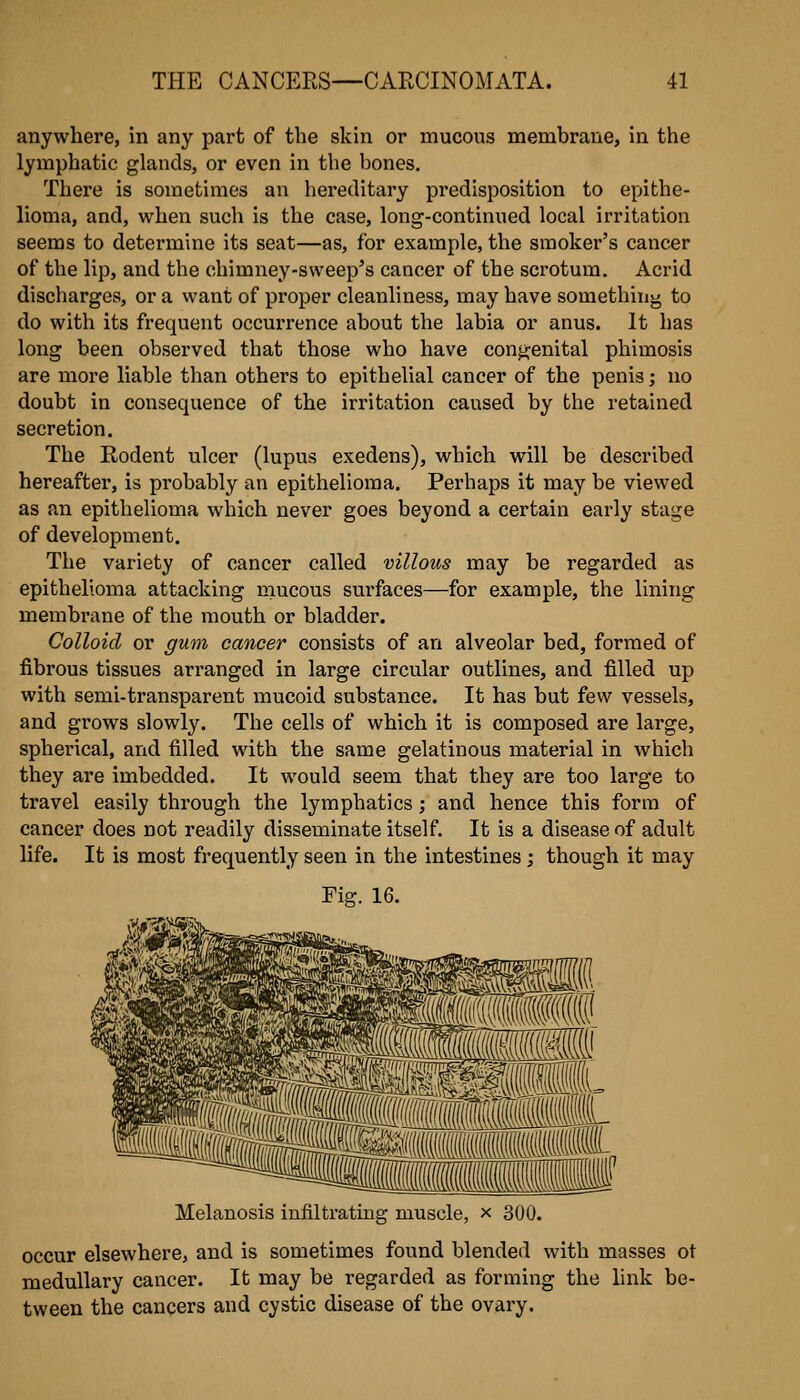 anywhere, in any part of the skin or mucous membrane, in the lymphatic glands, or even in the bones. There is sometimes an hereditary predisposition to epithe- lioma, and, when such is the case, long-continued local irritation seems to determine its seat—as, for example, the smoker's cancer of the lip, and the chimney-sweep's cancer of the scrotum. Acrid discharges, or a want of proper cleanliness, may have something to do with its frequent occurrence about the labia or anus. It has long been observed that those who have congenital phimosis are more liable than others to epithelial cancer of the penis; no doubt in consequence of the irritation caused by the retained secretion. The Eodent ulcer (lupus exedens), which will be described hereafter, is probably an epithelioma. Perhaps it may be viewed as an epithelioma which never goes beyond a certain early stage of development. The variety of cancer called villous may be regarded as epithelioma attacking niucous surfaces—for example, the lining membrane of the mouth or bladder. Colloid or gum cancer consists of an alveolar bed, formed of fibrous tissues arranged in large circular outlines, and filled up with semi-transparent mucoid substance. It has but few vessels, and grows slowly. The cells of which it is composed are large, spherical, and filled with the same gelatinous material in which they are imbedded. It would seem that they are too large to travel easily through the lymphatics ; and hence this form of cancer does not readily disseminate itself. It is a disease of adult life. It is most frequently seen in the intestines; though it may Fig. 16. Melanosis infiltrating muscle, x 300. occur elsewhere, and is sometimes found blended with masses ot medullary cancer. It may be regarded as forming the link be- tween the cancers and cystic disease of the ovary.
