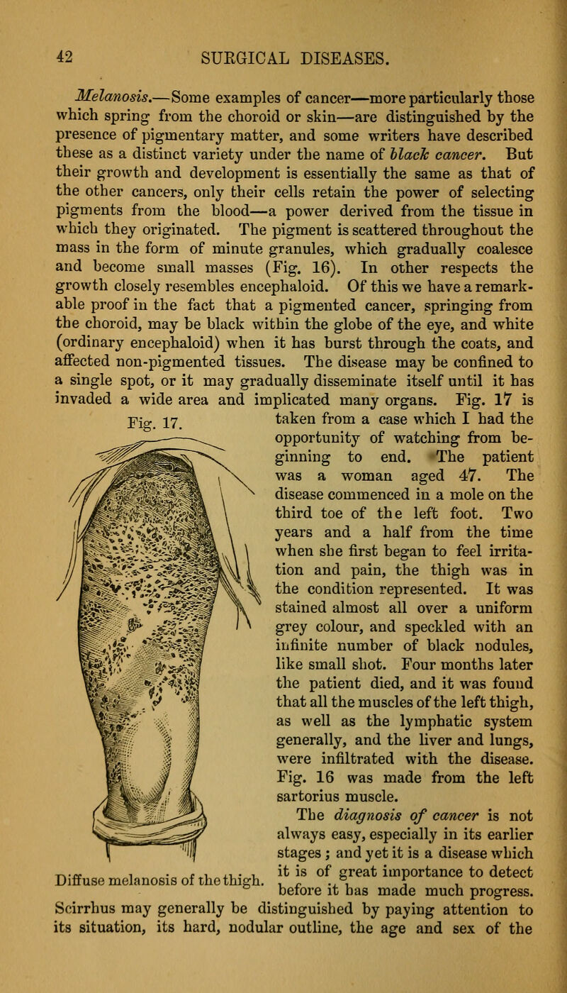 Melanosis.—Some examples of cancer—more particularly those which spring from the choroid or skin—are distinguished by the presence of pigmentary matter, and some writers have described these as a distinct variety under the name of llacJc cancer. But their growth and development is essentially the same as that of the other cancers, only their cells retain the power of selecting pigments from the blood—a power derived from the tissue in which they originated. The pigment is scattered throughout the mass in the form of minute granules, which gradually coalesce and become small masses (Fig. 16). In other respects the growth closely resembles encephaloid. Of this we have a remark- able proof in the fact that a pigmented cancer, springing from the choroid, may be black within the globe of the eye, and white (ordinary encephaloid) when it has burst through the coats, and affected non-pigmented tissues. The disease may be confined to a single spot, or it may gradually disseminate itself until it has invaded a wide area and implicated many organs. Tig. 17 is taken from a case which I had the opportunity of watching from be- ginning to end. The patient was a woman aged 47. The disease commenced in a mole on the third toe of the left foot. Two years and a half from the time when she first began to feel irrita- tion and pain, the thigh was in the condition represented. It was stained almost all over a uniform grey colour, and speckled with an infinite number of black nodules, like small shot. Four months later the patient died, and it was found that all the muscles of the left thigh, as well as the lymphatic system generally, and the liver and lungs, were infiltrated with the disease. Fig. 16 was made from the left sartorius muscle. The diagnosis of cancer is not always easy, especially in its earlier stages; and yet it is a disease which it is of great importance to detect before it has made much progress. Scirrhus may generally be distinguished by paying attention to its situation, its hard, nodular outline, the age and sex of the Diffuse melanosis of the thigh.