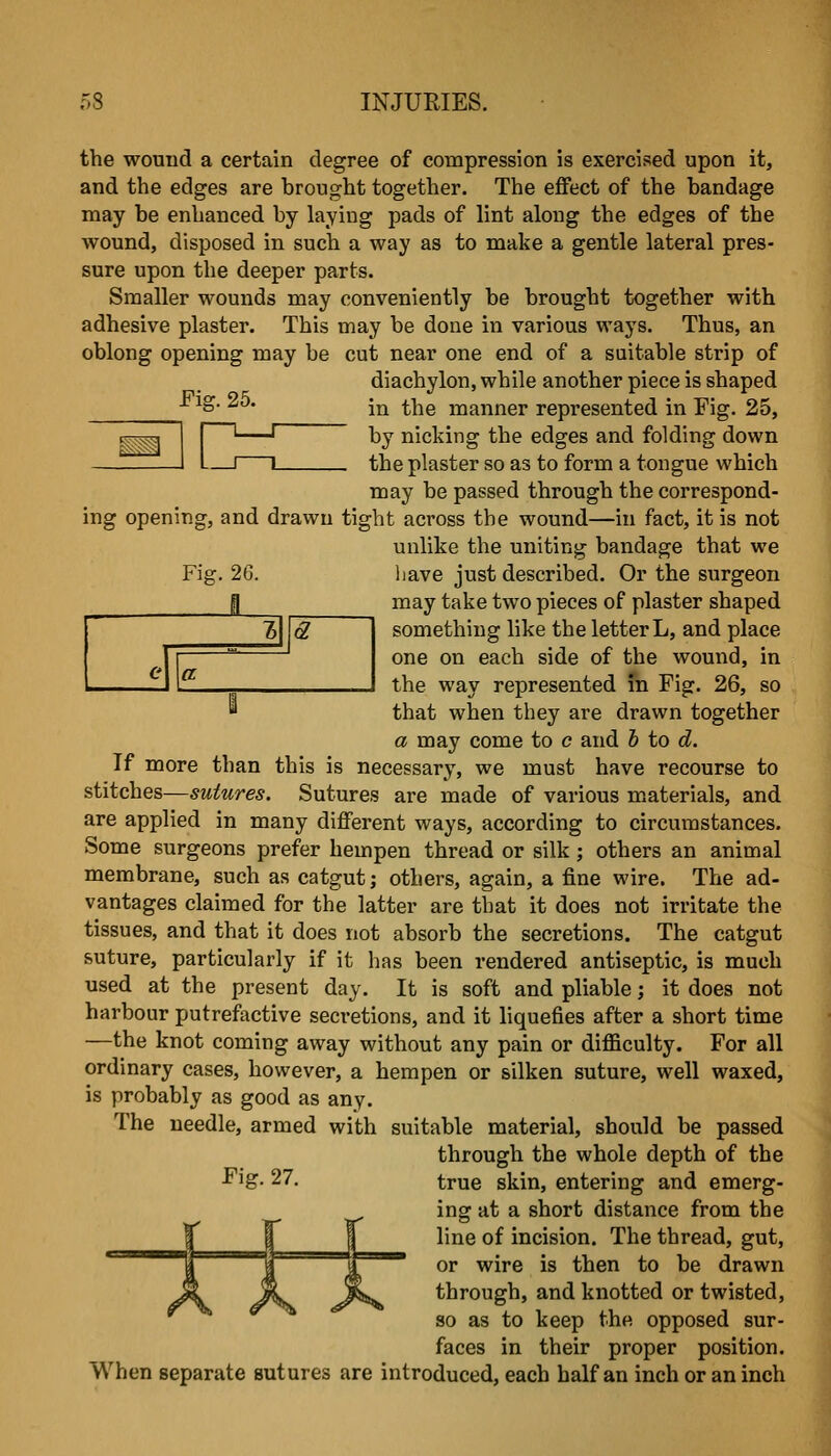 Fie:. 26. ^ a e a the wouud a certain degree of compression is exercised upon it, and the edges are hrought together. The effect of the bandage may be enhanced by laying pads of lint along the edges of the wound, disposed in such a way as to make a gentle lateral pres- sure upon the deeper parts. Smaller wounds may conveniently be brought together with adhesive plaster. This may be done in various ways. Thus, an oblong opening may be cut near one end of a suitable strip of diachylon, while another piece is shaped in the manner represented in Fig. 25, by nicking the edges and folding down the plaster so as to form a tongue which may be passed through the correspond- ing opening, and drawn tight across the wound—in fact, it is not unlike the uniting bandage that we liave just described. Or the surgeon may take two pieces of plaster shaped something like the letter L, and place one on each side of the wound, in the way represented m Fig. 26, so '^ that when they are drawn together a may come to c and h to d. If more than this is necessary, we must have recourse to stitches—sutures. Sutures are made of various m.aterials, and are applied in many different ways, according to circumstances. Some surgeons prefer hempen thread or silk ; others an animal membrane, such as catgut; others, again, a fine wire. The ad- vantages claimed for the latter are that it does not irritate the tissues, and that it does not absorb the secretions. The catgut suture, particularly if it has been rendered antiseptic, is much used at the present day. It is soft and pliable; it does not harbour putrefactive secretions, and it liquefies after a short time —the knot coming away without any pain or difficulty. For all ordinary cases, however, a hempen or silken suture, well waxed, is probably as good as any. The needle, armed with suitable material, should be passed through the whole depth of the ^ig- 27. true skin, entering and emerg- ing at a short distance from the line of incision. The thread, gut, or wire is then to be drawn through, and knotted or twisted, so as to keep the opposed sur- faces in their proper position. When separate sutures are introduced, each half an inch or an inch