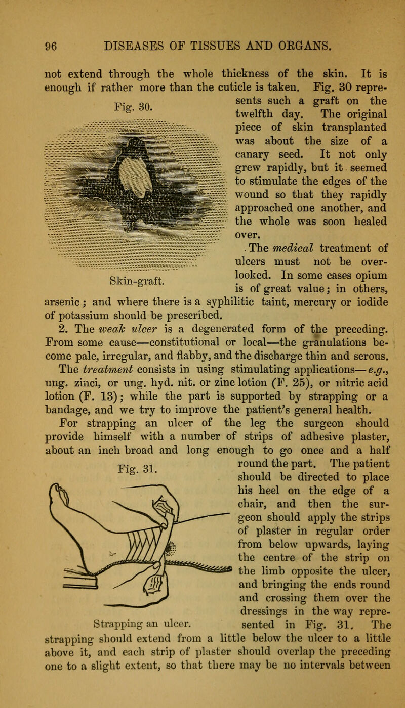 Skin-graft. not extend through the whole thickness of the skin. It is enough if rather more than the cuticle is taken. Fig. 30 repre- -p. OA sents such a graft on the twelfth day. The original piece of skin transplanted was about the size of a canary seed. It not only grew rapidly, but it seemed to stimulate the edges of the wound so that they rapidly approached one another, and the whole was soon healed over. . The medical treatment of ulcers must not be over- looked. In some cases opium is of great value; in others, arsenic; and where there is a syphilitic taint, mercury or iodide of potassium should be prescribed. 2. The weaTc ulcer is a degenerated form of the preceding. From some cause—constitutional or local—the granulations be- come pale, irregular, and flabby, and the discharge thin and serous. The treatment consists in using stimulating applications—e.g., ung. zinci, or ung. hyd. nit. or zinc lotion (F. 25), or nitric acid lotion (F, 13); while the part is supported by strapping or a bandage, and we try to improve the patient's general health. For strapping an ulcer of the leg the surgeon should provide himself with a number of strips of adhesive plaster, about an inch broad and long enough to go once and a half -p. Qi round the part. The patient should be directed to place his heel on the edge of a chair, and then the sur- geon should apply the strips of plaster in regular order from below upwards, laying the centre of the strip on the limb opposite the ulcer, and bringing the ends round and crossing them over the dressings in the way repre- Strapping an ulcer. sented in Fig. 31. The strapping should extend from a little below the ulcer to a little above it, and each strip of plaster should overlap the preceding one to a slight extent, so that there may be no intervals between