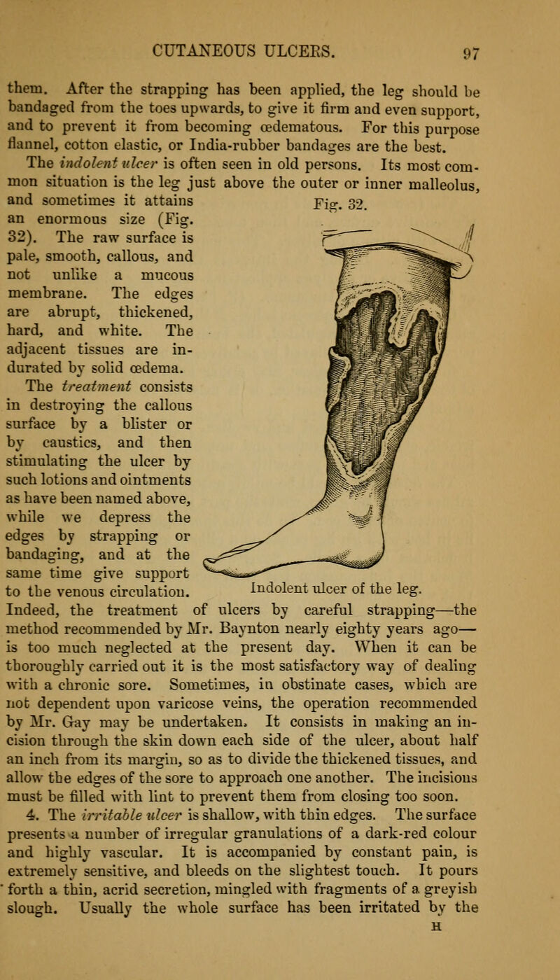 them. After the strapping has been applied, the leg should be bandaged from the toes upwards, to give it firm and even support, and to prevent it from becoming cedematous. For this purpose flannel, cotton elastic, or India-rubber bandages are the best. The indolent ulcer is often seen in old persons. Its most com- mon situation is the leg just above the outer or inner malleolus. Fig. 32 and sometimes it attains an enormous size (Fig. 32). The raw surface is pale, smooth, callous, and not unlike a mucous membrane. The edges are abrupt, thickened, hard, and white. The adjacent tissues are in- durated by solid oedema. The treatment consists in destroying the callous surface by a blister or by caustics, and then stimulating the ulcer by such lotions and ointments as have been named above, while we depress the edges by strapping or bandaging, and at the same time give support to the venous circulation. Indolent iilcer of the leg. Indeed, the treatment of ulcers by careful strapping—the method recommended by Mr. Baynton nearly eighty years ago— is too much neglected at the present day. When it can be thoroughly carried out it is the most satisfactory way of dealing with a chronic sore. Sometimes, in obstinate cases, which are not dependent upon varicose veins, the operation recommended by Mr. Gay may be undertaken. It consists in making an in- cision through the skin down each side of the ulcer, about half an inch from its margin, so as to divide the thickened tissues, and allow the edges of the sore to approach one another. The incisions must be filled with lint to prevent them from closing too soon. 4. The irritable nicer is shallow, with thin edges. The surface presents a number of irregular granulations of a dark-red colour and highly vascular. It is accompanied by constant pain, is extremely sensitive, and bleeds on the slightest touch. It pours forth a thin, acrid secretion, mingled with fragments of a greyish slough. Usually the whole surface has been irritated by the u