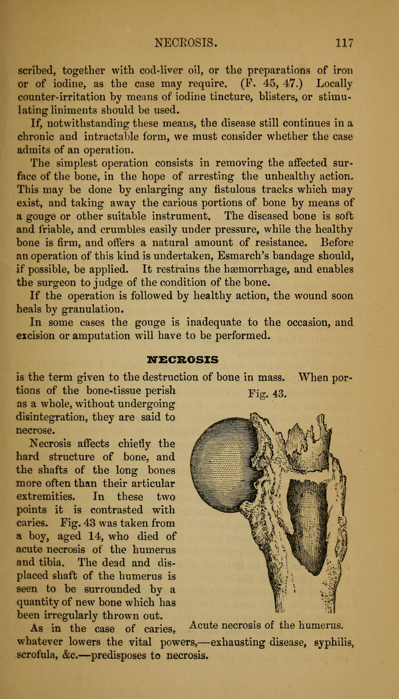 scribed, together with cod-liver oil, or the preparations of iron or of iodine, as the case may require. (P. 45, 47.) Locally counter-irritation by means of iodine tincture, blisters, or stimu- lating liniments should be used. If, notwithstanding these means, the disease still continues in a chronic and intractable form, we must consider whether the case admits of an operation. Tlie simplest operation consists in removing the affected sur- face of the bone, in the hope of arresting the unhealthy action. This may be done by enlarging any fistulous tracks which may exist, and taking away the cai'ious portions of bone by means of a gouge or other suitable instrument. The diseased bone is soft and friable, and crumbles easily under pressure, while the healthy bone is firm, and offers a natural amount of resistance. Before an operation of this kind is undertaken, Esmarch's bandage should, if possible, be applied. It restrains the haemorrhage, and enables the surgeon to judge of the condition of the bone. If the operation is followed by healthy action, the wound soon heals by granulation. In some cases the gouge is inadequate to the occasion, and excision or amputation will have to be performed. ig-ECROSIS is the term given to the destruction of bone in mass. When por- Fig. 43. tions of the bone-tissue perish as a whole, without undergoing disintegration, they are said to necrose. Necrosis affects chiefly the hard structure of bone, and the shafts of the long bones more often than their articular extremities. In these two points it is contrasted with caries. Fig. 43 was taken from a boy, aged 14, who died of acute necrosis of the humerus and tibia. The dead and dis- placed shaft of the humerus is seen to be surrounded by a quantity of new bone which has been irregularly thrown out. As in the case of caries, ^'^^^ necrosis of the humerus, whatever lowers the vital powers,—exhausting disease, syphilis, scrofula, &c.—predisposes to necrosis.