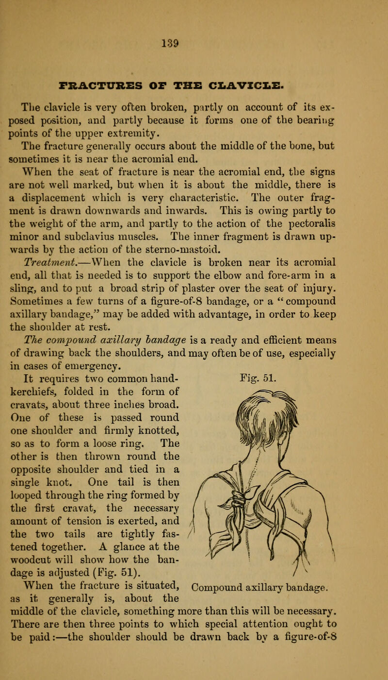 FRACTURES OF THB CIiAVICIiX:. The clavicle is very often broken, pirtly on account of its ex- posed position, and partly because it forms one of the bearing points of the upper extremity. The fracture generally occurs about the middle of the bone, but sometimes it is near the acromial end. When the seat of fracture is near the acromial end, the signs are not well marked, but when it is about the middle, there is a displacement which is very characteristic. The outer frag- ment is drawn downwards and inwards. This is owing partly to the weight of the arm, and partly to the action of the pectoralis minor and subclavius muscles. The inner fragment is drawn up- wards by the action of the sterno-mastoid. Treatment.—When the clavicle is broken near its acromial end, all that is needed is to support the elbow and fore-arm in a sling, and to put a broad strip of plaster over the seat of injury. Sometimes a few turns of a figure-of-8 bandage, or a  compound axillary bandage, may be added with advantage, in order to keep the shoulder at rest. The compound axillary handage is a ready and efficient means of drawing back the shoulders, and may often be of use, especially in cases of emergency. It requires two common hand- kerchiefs, folded in the form of cravats, about three inches broad. One of these is passed round one shoulder and firmly knotted, so as to form a loose ring. The other is then thrown round the opposite shoulder and tied in a single knot. One tail is then looped through the ring formed by the first cravat, the necessary amount of tension is exerted, and the two tails are tightly fas- tened together. A glance at the woodcut will show how the ban- dage is adjusted (Fig. 51). When the fracture is situated, as it generally is, about the middle of the clavicle, something more than this will be necessary. There are then three points to which special attention ought to be paid:—the shoulder should be drawn back by a figure-of-8 Fisr. 51. Compound axillary bandage.
