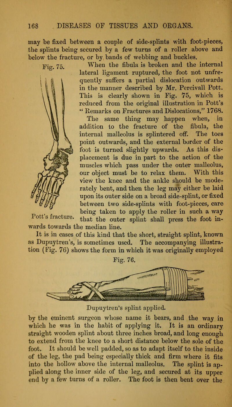 may be fixed between a couple of side-splints with foot-pieces, the splints being secured by a few turns of a roller above and below the fracture, or by bands of webbing and buckles. Fig. 75. When the fibula is broken and the internal lateral ligament ruptured, the foot not unfre- quently suffers a partial dislocation outwards in the manner described by Mr. Percivall Pott. This is clearly shown in Fig. 75, which is reduced from the original illustration in Pott's  Remarks on Fractures and Dislocations, 1768. The same thing may happen when, in addition to the fracture of the fibula, the internal malleolus is splintered ofi. The toes point outwards, and the external border of the foot is turned slightly upwards. As this dis- placement is due in part to the action of the muscles which pass under the outer malleolus, our object must be to relax them. With this view the knee and the ankle should be mode- rately bent, and then the leg may either be laid upon its outer side on a broad side-splint, or fixed between two side-splints with foot-pieces, care being taken to apply the roller in such a way that the outer splint shall press the foot in- wards towards the median line. It is in cases of this kind that tbe short, straight splint, known as Dupujtren's, is sometimes used. Tbe accompanying illustra- tion (Fig. 76) shows the form in which it was originally employed Fig-. 76. Pott's fracture. Dupuytren's splint applied. by the eminent surgeon whose name it bears, and the way in which he was in the habit of applying it. It is an ordinary straight wooden splint about three inches broad, and long enough to extend from the knee to a short distance below the sole of the foot. It should be well padded, so as to adapt itself to the inside of the leg, the pad being especially thick and firm where it fits into tbe hollow above the internal malleolus. The splint is ap- plied along the inner side of the leg, and secured at its upper end by a few turns of a roller. The foot is then bent over the