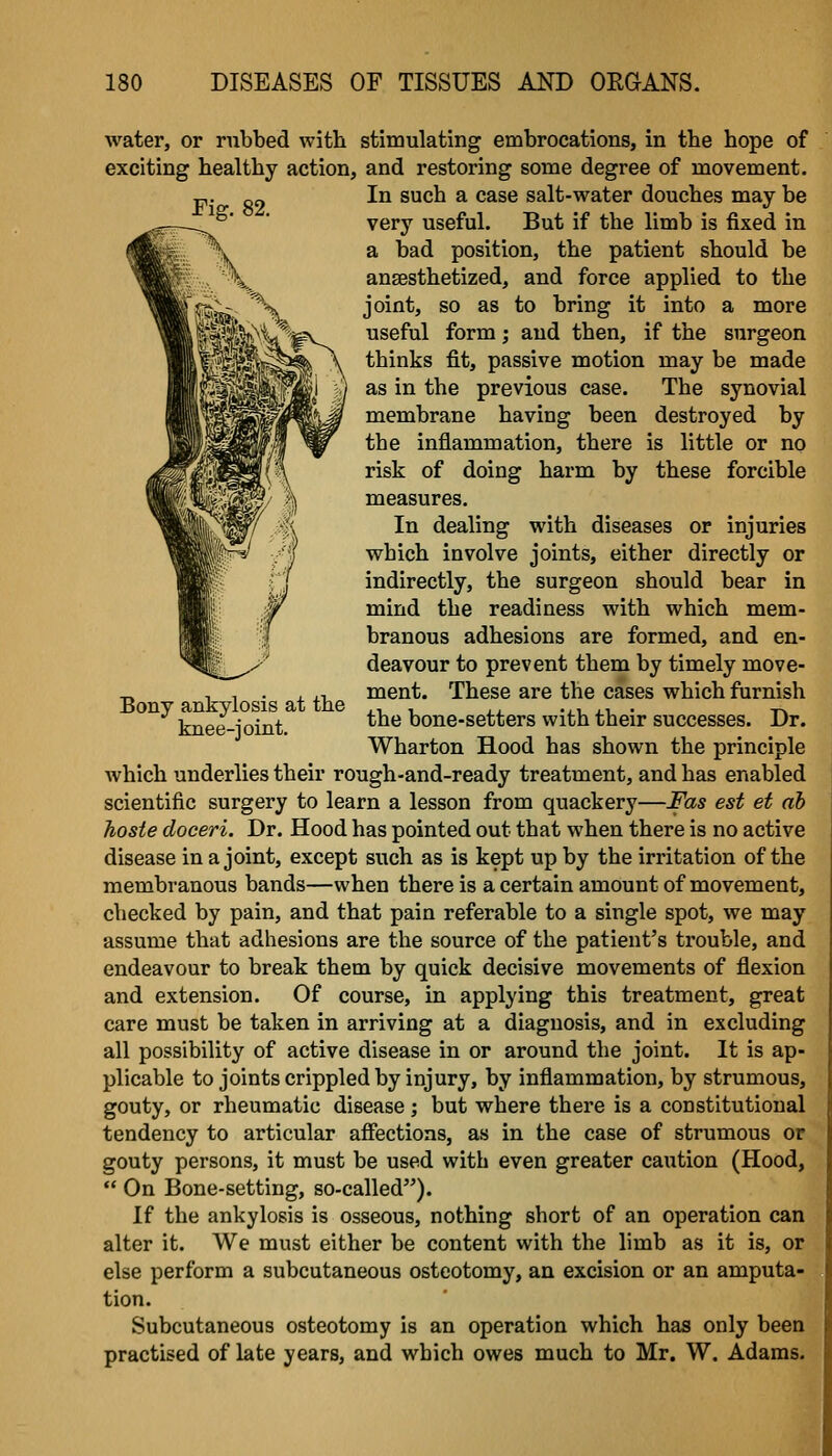 Bony ankylosis at the knee-joint. water, or rubbed with stimulating embrocations, in the hope of exciting healthy action, and restoring some degree of movement. In such a case salt-water douches may be very useful. But if the limb is fixed in a bad position, the patient should be anaesthetized, and force applied to the joint, so as to bring it into a more useful form; and then, if the surgeon thinks fit, passive motion may be made as in the previous case. The synovial membrane having been destroyed by the inflammation, there is little or no risk of doing harm by these forcible measures. In dealing with diseases or injuries which involve joints, either directly or indirectly, the surgeon should bear in mind the readiness with which mem- branous adhesions are formed, and en- deavour to prevent them by timely move- ment. These are the cases which furnish the bone-setters with their successes. Dr. Wharton Hood has shown the principle which underlies their rough-and-ready treatment, and has enabled scientific surgery to learn a lesson from quackery—Fas est et ah hoste doceri. Dr. Hood has pointed out that when there is no active disease in a joint, except such as is kept up by the irritation of the membranous bands—when there is a certain amount of movement, checked by pain, and that pain referable to a single spot, we may assume that adhesions are the source of the patient's trouble, and endeavour to break them by quick decisive movements of flexion and extension. Of course, in applying this treatment, great care must be taken in arriving at a diagnosis, and in excluding all possibility of active disease in or around the joint. It is ap- plicable to joints crippled by injury, by inflammation, by strumous, gouty, or rheumatic disease ; but where there is a constitutional tendency to articular affections, as in the case of strumous or gouty persons, it must be used with even greater caution (Hood,  On Bone-setting, so-called). If the ankylosis is osseous, nothing short of an operation can alter it. We must either be content with the limb as it is, or else perform a subcutaneous osteotomy, an excision or an amputa- tion. Subcutaneous osteotomy is an operation which has only been practised of late years, and which owes much to Mr. W. Adams.