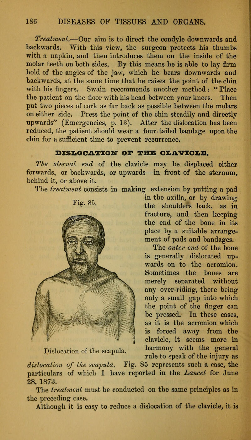 Treatment.—Our aim is to direct the condyle downwards and backwards. With this view, the surgeon protects his thumbs with a napkin, and then introduces them on the inside of the molar teeth on both sides. By this means he is able to lay firm hold of the angles of the jaw, which he bears downwards and backwards, at the same time that he raises the point of the chin with his fingers, Swain recommends another method: Place the patient on the floor with his head between yoiar knees. Then put two pieces of cork as far back as possible between the molars on either side. Press the point of the chin steadily and directly upwards (Emergencies, p. 13). After the dislocation has been reduced, the patient should wear a four-tailed bandage upon the chin for a suflacient time to prevent recurrence. BISIiOCATIOir OF TBB CX.AVXCI.E. The sternal end of the clavicle may be displaced either forwards, or backwards, or upwards—in front of the sternum, behind it, or above it. The treatment consists in making extension by putting a pad in the axilla, or by drawing ^^ the shoulders back, as in fracture, and then keeping the end of the bone in its place by a suitable arrange- ment of pads and bandages. The outer end of the bone is generally dislocated up- wards on to the acromion. Sometimes the bones are merely separated without any over-riding, there being only a small gap into which the point of the finger can be pressed. In these cases, as it is the acromion which is forced away from the clavicle, it seems more in harmony with the general rule to speak of the injury as dislocation of the scapula. Fig. 85 represents such a case, the particulars of which 1 have reported in the Lancet for June 28, 1873. The treatment must be conducted on the same principles as in the preceding case. Although it is easy to reduce a dislocation of the clavicle, it is Dislocation of the scapula.