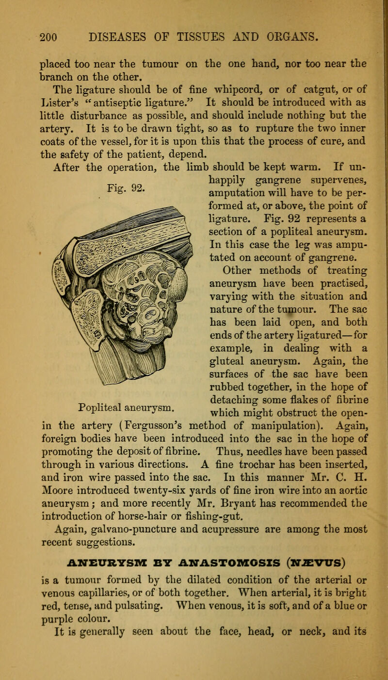 placed too near the tumour on the one hand, nor too near the branch on the other. The ligature should be of fine whipcord, or of catgut, or of Lister's  antiseptic ligature. It should be introduced with as little disturbance as possible, and should include nothing but the artery. It is to be drawn tight, so as to rupture the two inner coats of the vessel, for it is upon this that the process of cure, and the safety of the patient, depend. After the operation, the limb should be kept warm. If un- happily gangrene supervenes. Fig. 92. Popliteal aneurysm. amputation will have to be per- formed at, or above, the point of ligature. Fig. 92 represents a section of a popliteal aneurysm. In this case the leg was ampu- tated on account of gangrene. Other methods of treating aneurysm have been practised, varying with the situation and nature of the tumour. The sac has been laid open, and both ends of the artery ligatured—for example, in dealing with a gluteal aneurysm. Again, the surfaces of the sac have been rubbed together, in the hope of detaching some flakes of fibrine which might obstruct the open- in the artery (Fergusson's method of manipulation). Again, foreign bodies have been introduced into the sac in the hope of promoting the deposit of fibrine. Thus, needles have been passed through in various directions. A fine trochar has been inserted, and iron wire passed into the sac. In this manner Mr. C. H. Moore introduced twenty-six yards of fine iron wire into an aortic aneurysm; and more recently Mr. Bryant has recommended the introduction of horse-hair or fishing-gut. Again, galvano-puncture and acupressure are among the most recent suggestions. ANEURTSIVX B7 AXTASTOMOSZS (ITAIVUS) is a tumour formed by the dilated condition of the arterial or venous capillaries, or of both together. When arterial, it is bright red, tense, and pulsating. When venous, it is soft, and of a blue or purple colour. It is generally seen about the face, head, or neck, and its