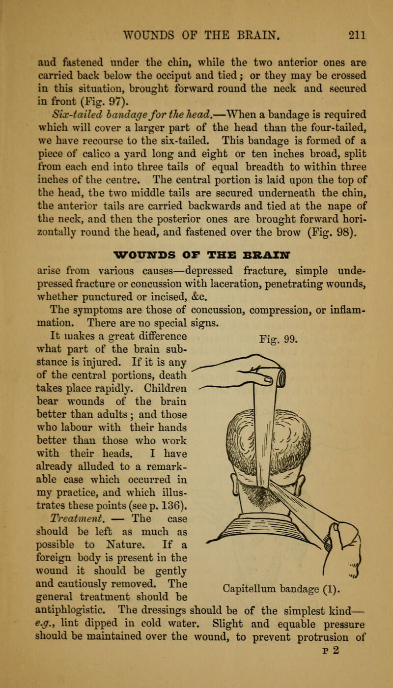 and fastened nnder the chin, while the two anterior ones are carried back below the occiput and tied; or they may be crossed in this situation, brought forward round the neck and secured in front (Fig. 97). Sir-failed bandage for the head,—\Yhen a bandage is required which will cover a larger part of the head than the four-tailed, we have recourse to the sbi-tailed. This bandage is formed of a piece of calico a yard long and eight or ten inches broad, split from each end into three tails of equal breadth to within three inches of the centre. The central portion is laid upon the top of the head, the two middle tails are secured underneath the chin, the anterior tails are carried backwards and tied at the nape of the neck, and then the posterior ones are brought forward hori- zontally round the head, and fastened over the brow (Fig. 98). WOTTxarDS of the BRAmr arise from various causes—depressed fracture, simple unde- pressed fracture or concussion with lacei'ation, penetrating wounds, whether punctured or incised, &c. The symptoms are those of concussion, compression, or inflam- mation. There are no special signs. It makes a great difference -pis 99. what part of the brain sub- stance is injured. If it is any of the central portions, death takes place rapidly. Children bear wounds of the brain better than adults ; and those who labour with their hands better than those who work with their heads. I have already alluded to a remark- able case which occurred in my practice, and which illus- trates these points (see p. 136). Treatment. — The case should be left as much as possible to Nature. If a foreign body is present in the wound it should be gently and cautiously removed. The general treatment should be antiphlogistic. The dressings should be of the simplest kind— e.g., lint dipped in cold water. Slight and equable pressure should be maintained over the wound, to prevent protrusion of p 2