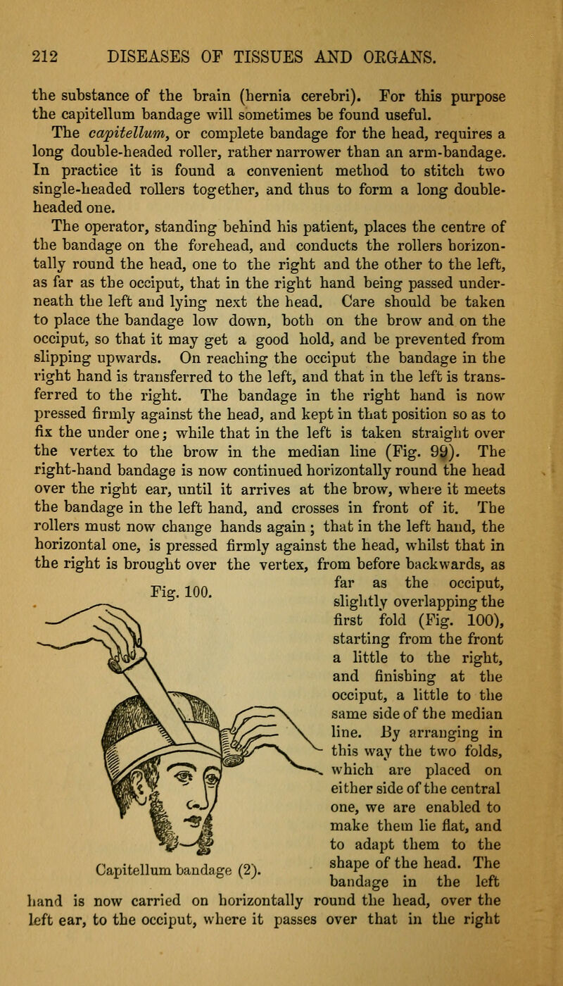 the substance of the brain (hernia cerebri). For this purpose the capitellum bandage will sometimes be found useful. The capitellum, or complete bandage for the head, requires a long double-headed roller, rather narrower than an arm-bandage. In practice it is found a convenient method to stitch two single-headed rollers together, and thus to form a long double- headed one. The operator, standing behind his patient, places the centre of the bandage on the forehead, and conducts the rollers horizon- tally round the head, one to the right and the other to the left, as far as the occiput, that in the right hand being passed under- neath the left and lying next the head. Care should be taken to place the bandage low down, both on the brow and on the occiput, so that it may get a good hold, and be prevented from slipping upwards. On reaching the occiput the bandage in the right hand is transferred to the left, and that in the left is trans- ferred to the right. The bandage in the right hand is now pressed firmly against the head, and kept in that position so as to fix the under one; while that in the left is taken straight over the vertex to the brow in the median line (Fig. 99). The right-hand bandage is now continued horizontally round the head over the right ear, until it arrives at the brow, where it meets the bandage in the left hand, and crosses in front of it. The rollers must now change hands again ; that in the left hand, the horizontal one, is pressed firmly against the head, whilst that in the right is brought over the vertex, from before backwards, as -p. ^QQ far as the occiput, ^' * slightly overlapping the first fold (Pig. 100), starting from the front a little to the right, and finishing at the occiput, a little to the same side of the median line. By arranging in this way the two folds, which are placed on either side of the central one, we are enabled to make them lie flat, and to adapt them to the shape of the head. The bandage in the left hand is now carried on horizontally round the head, over the left ear, to the occiput, where it passes over that in the right